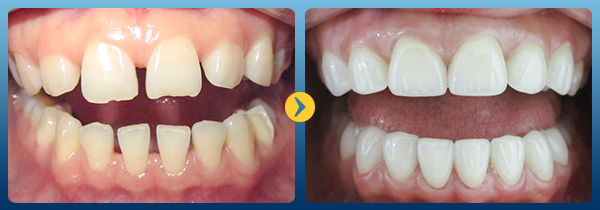 Bọc sứ còn giúp cho hàm răng trở nên trắng sáng và đều màu hơn.