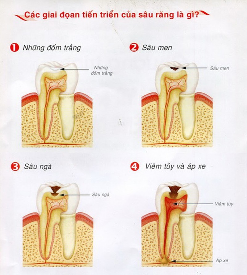 Các giai đoạn phát triển của bệnh sâu răng