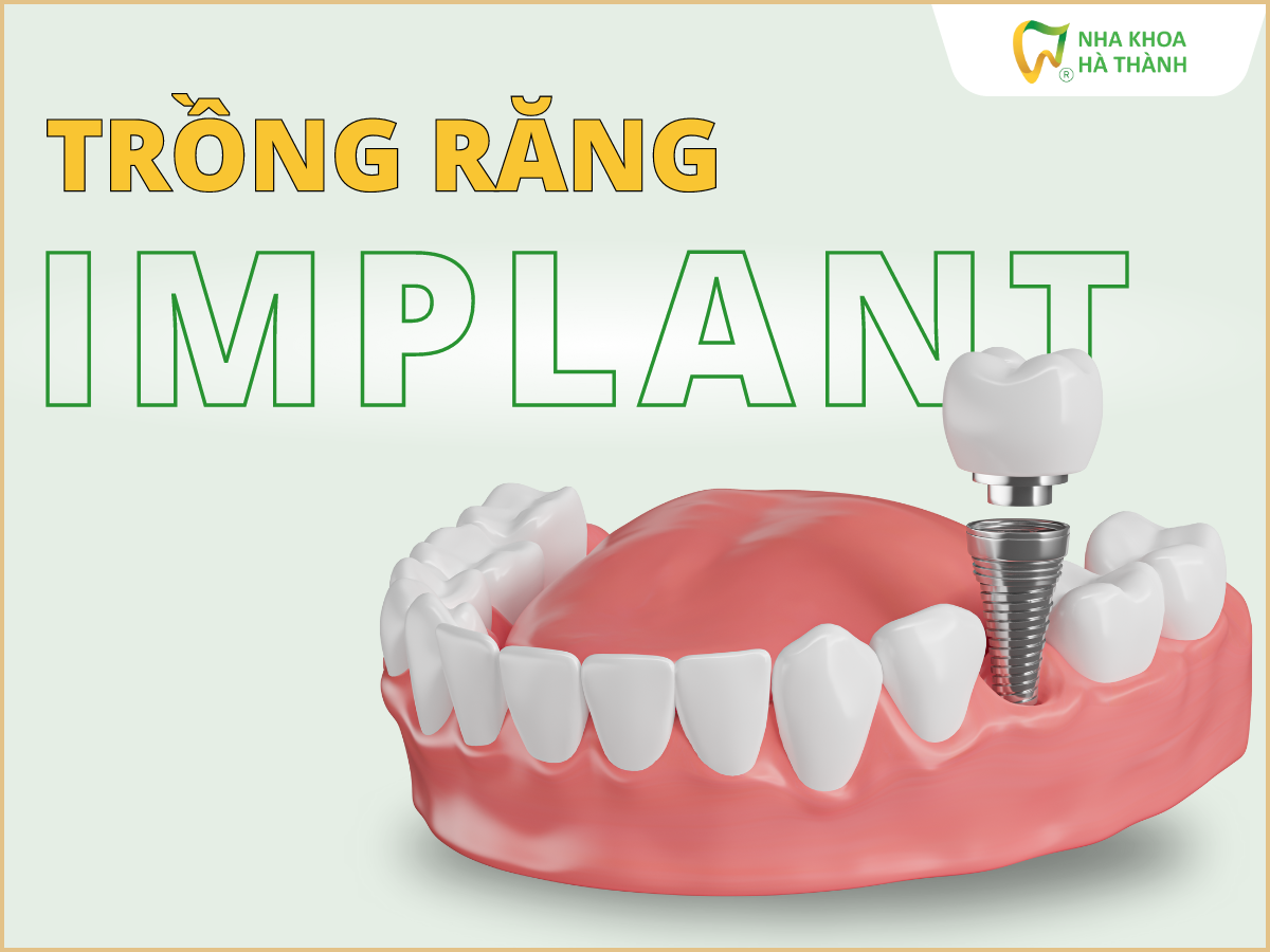 trong-rang-implant-nha-khoa-ha-thanh