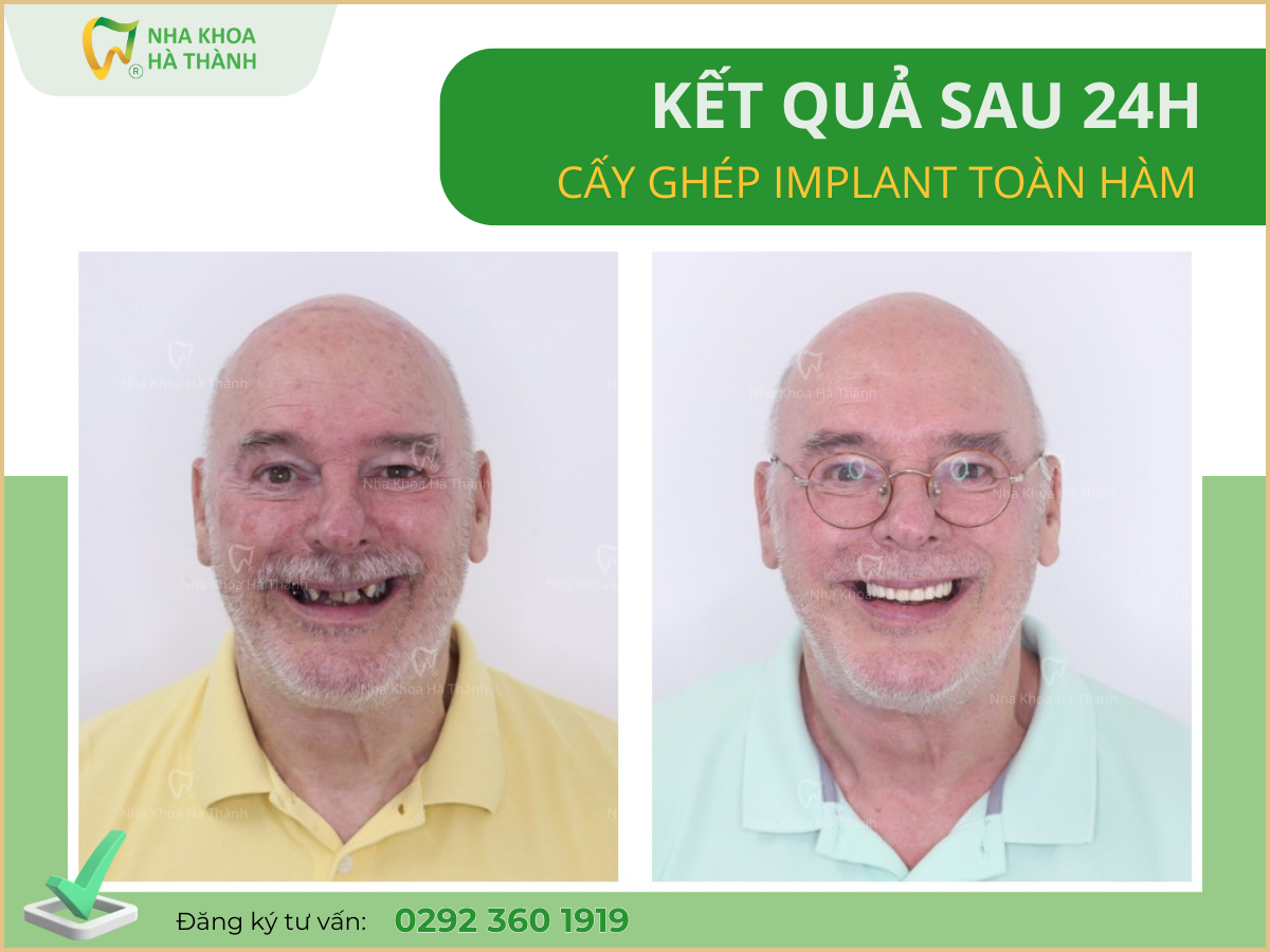 trong-rang-implant-nha-khoa-ha-thanh