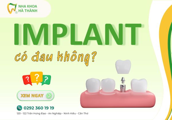 Implant-co-dau-khong-nha-khoa-ha-thanh