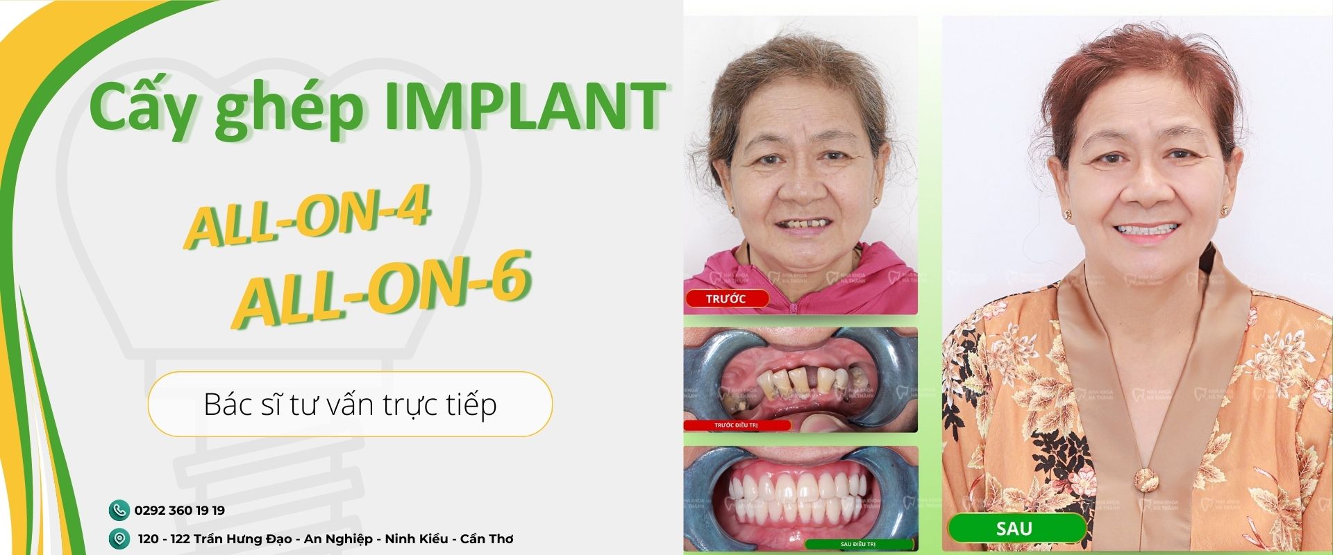 nha-khoa-ha-thanh-cay-ghep-implant-banner