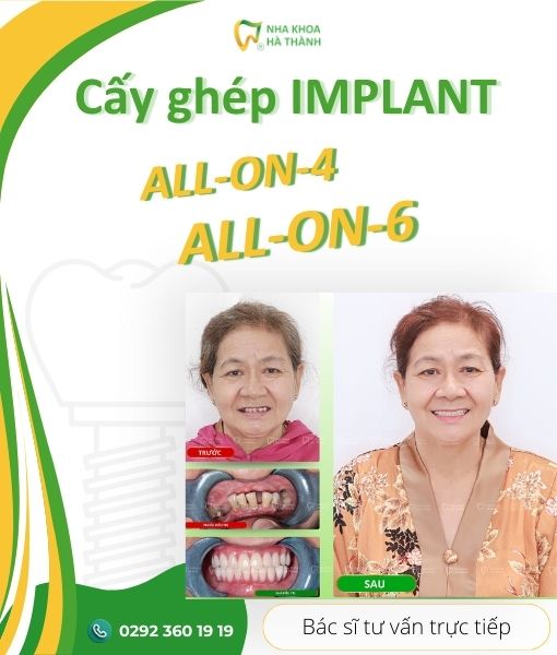 nha-khoa-ha-thanh-cay-ghep-implant-banner2