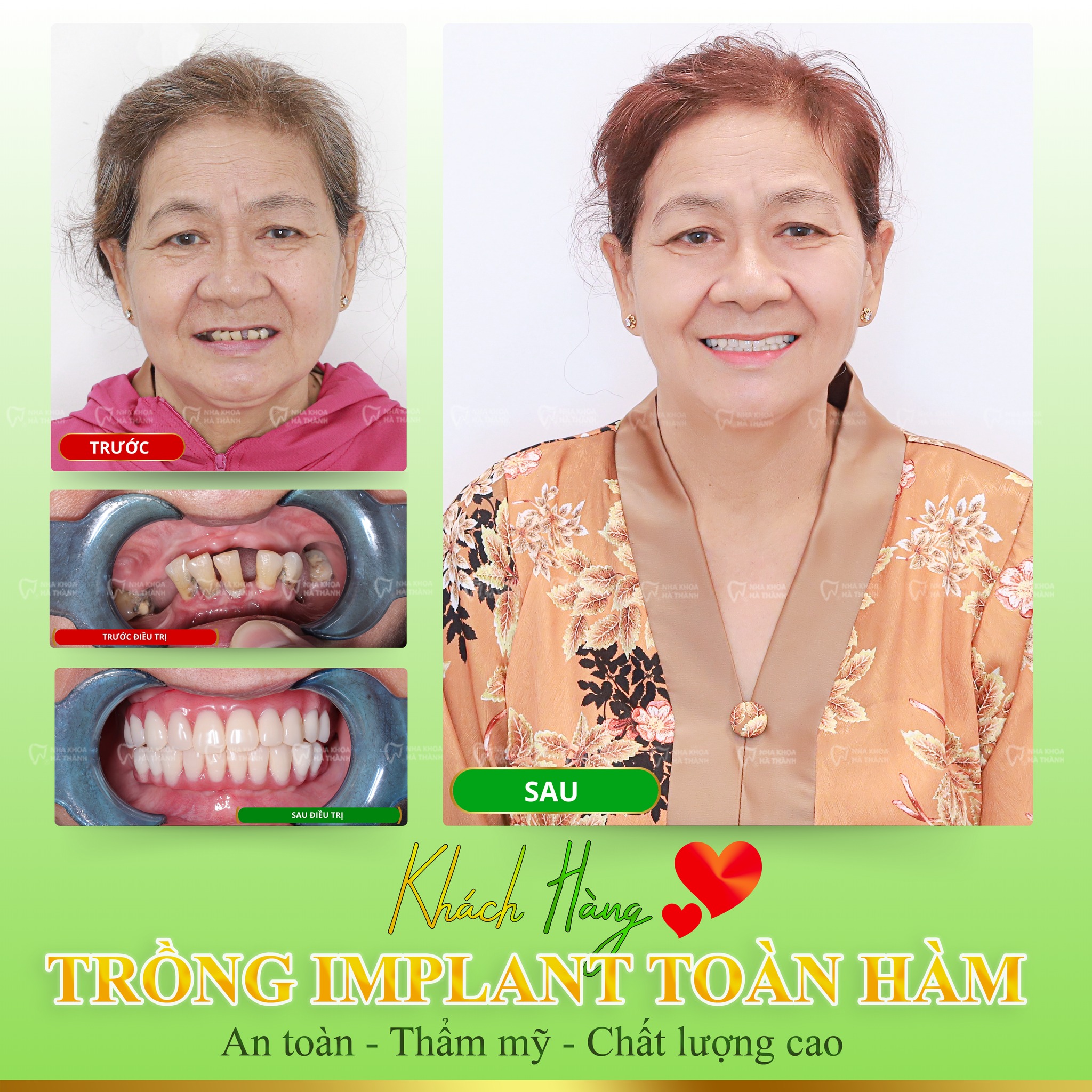 trong-rang-implant-nha-khoa-ha-thanh