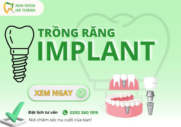 trong-rang-implant