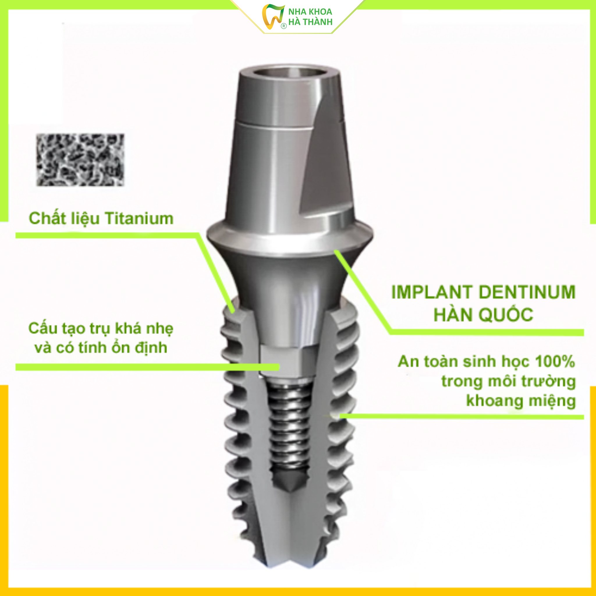 trong-rang-implant-nha-khoa-ha-thanh