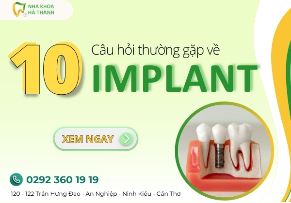 10-cau-hoi-thuong-gap-ve-implant