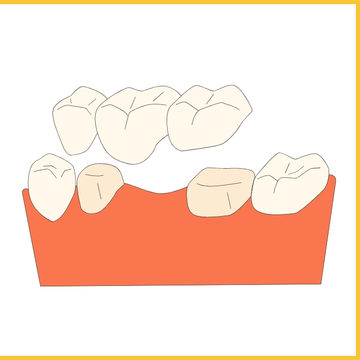 trong-rang-implant-ham-cau-rang-su-nha-khoa-ha-thanh