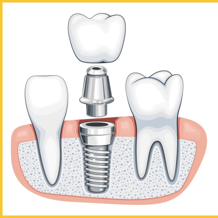 trong-rang-implant-ham-cau-rang-su-nha-khoa-ha-thanh