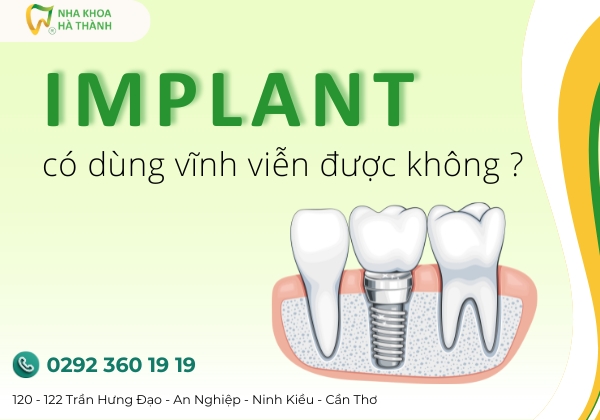 implant-nha-khoa-ha-thanh