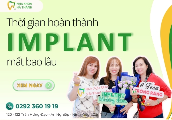 thoi-gian-hoan-thanh-implant-mat-bao-lau