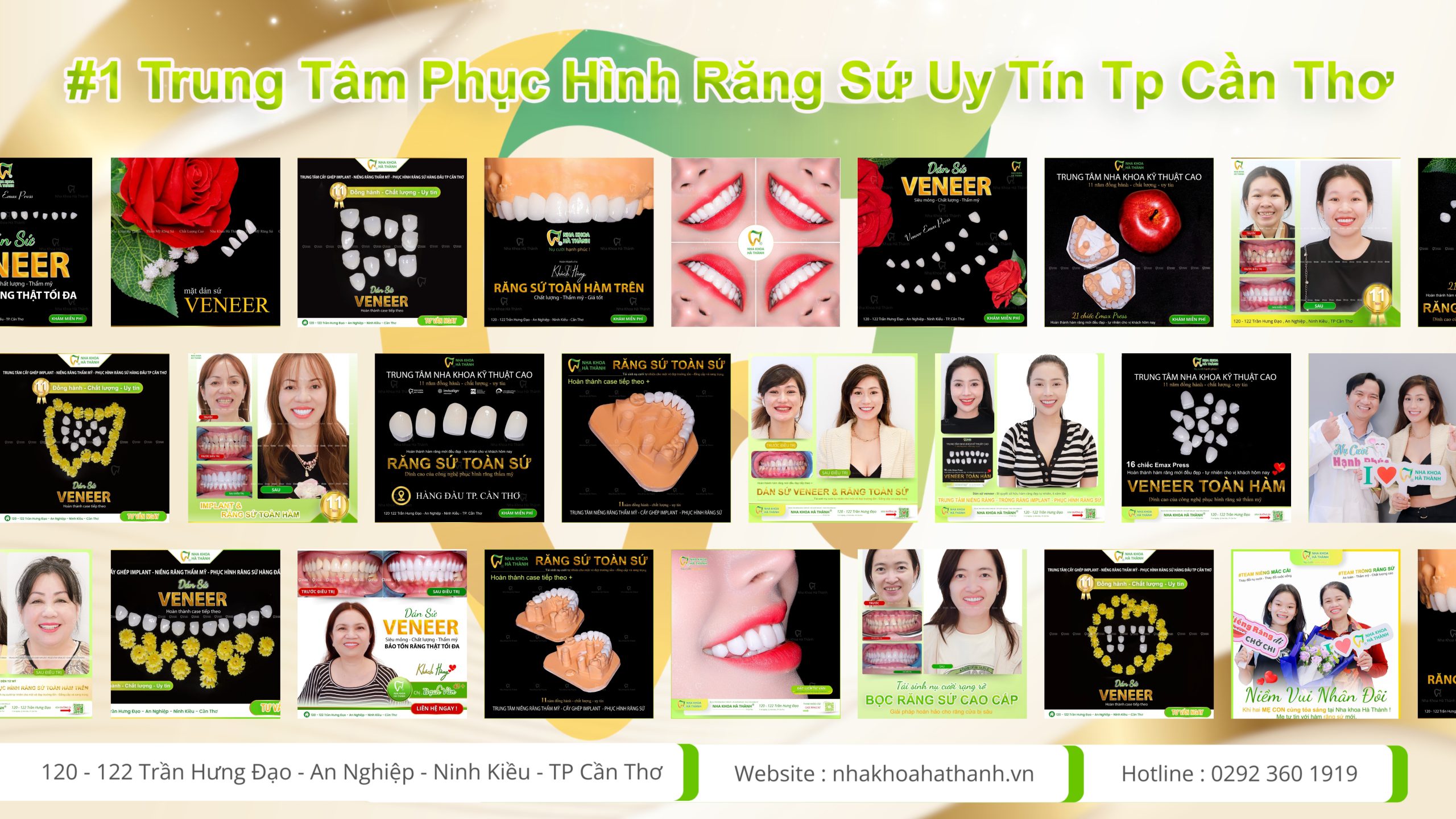 Nha khoa uy tín cần thơ-răng sứ-bọc răng sứ-dán sứ veneer-nha khoa hà thành 