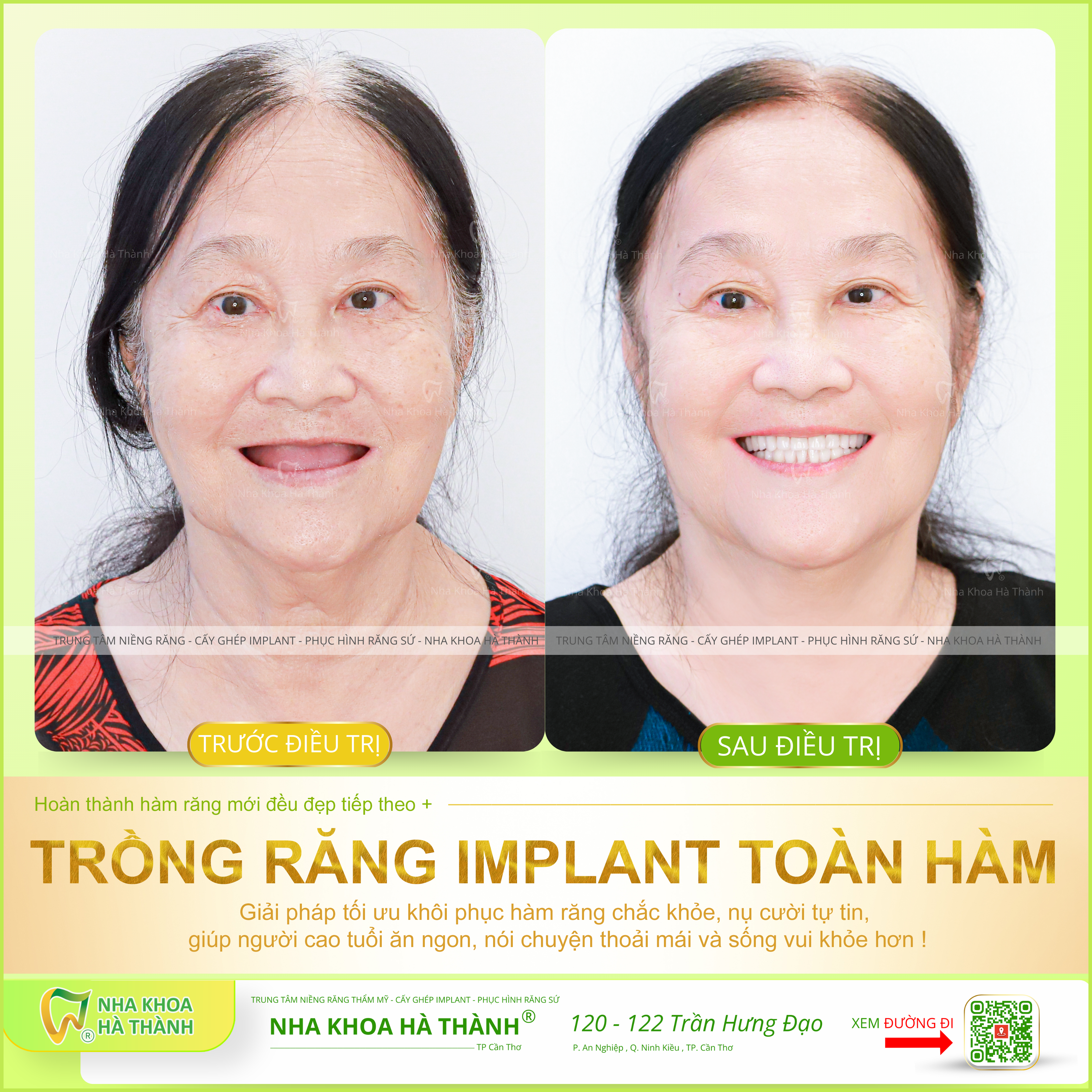 Trồng răng implant cho người bị mất nhiều răng / mất răng toàn hàm 