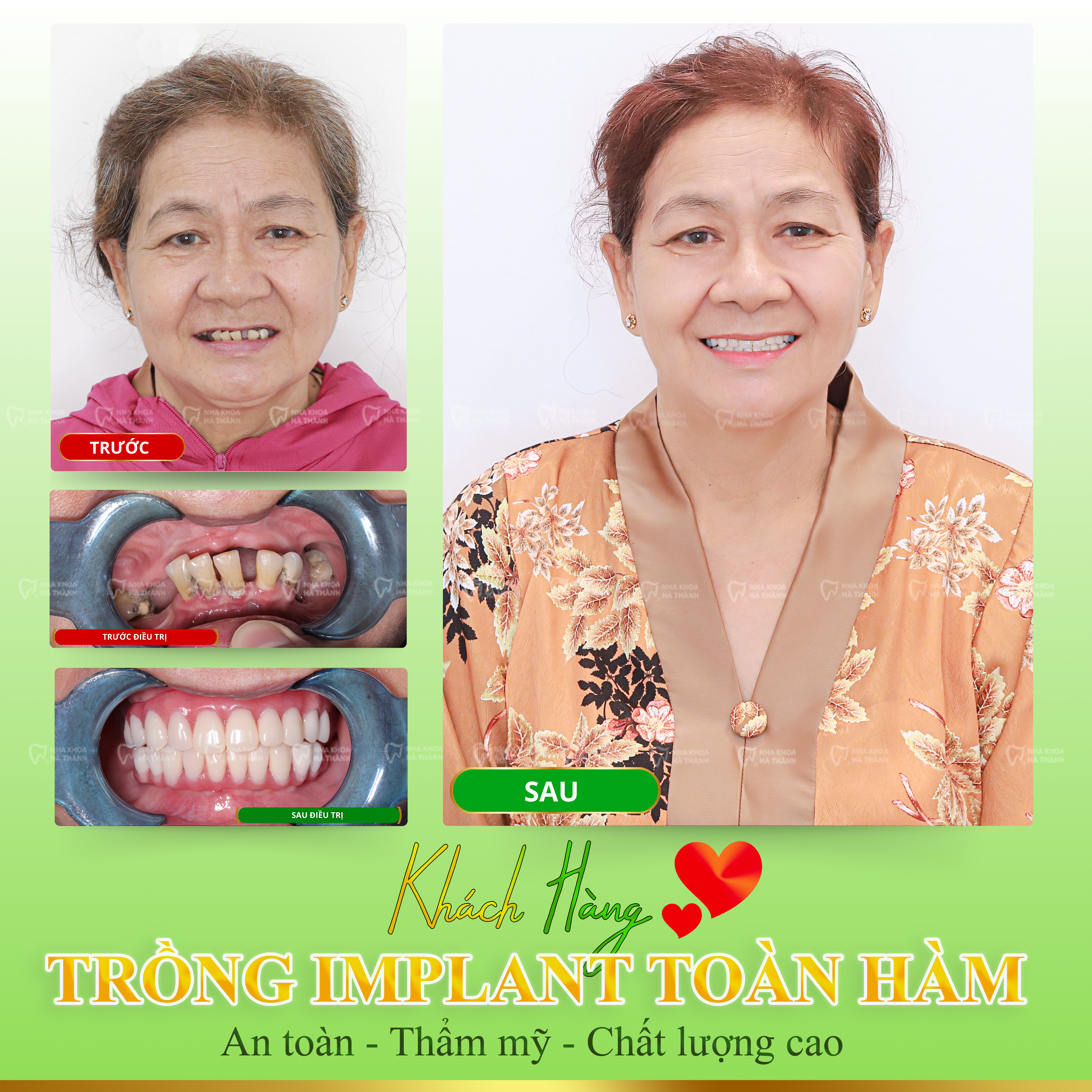 trồng răng implant toàn hàm uy tín ở Cần Thơ 