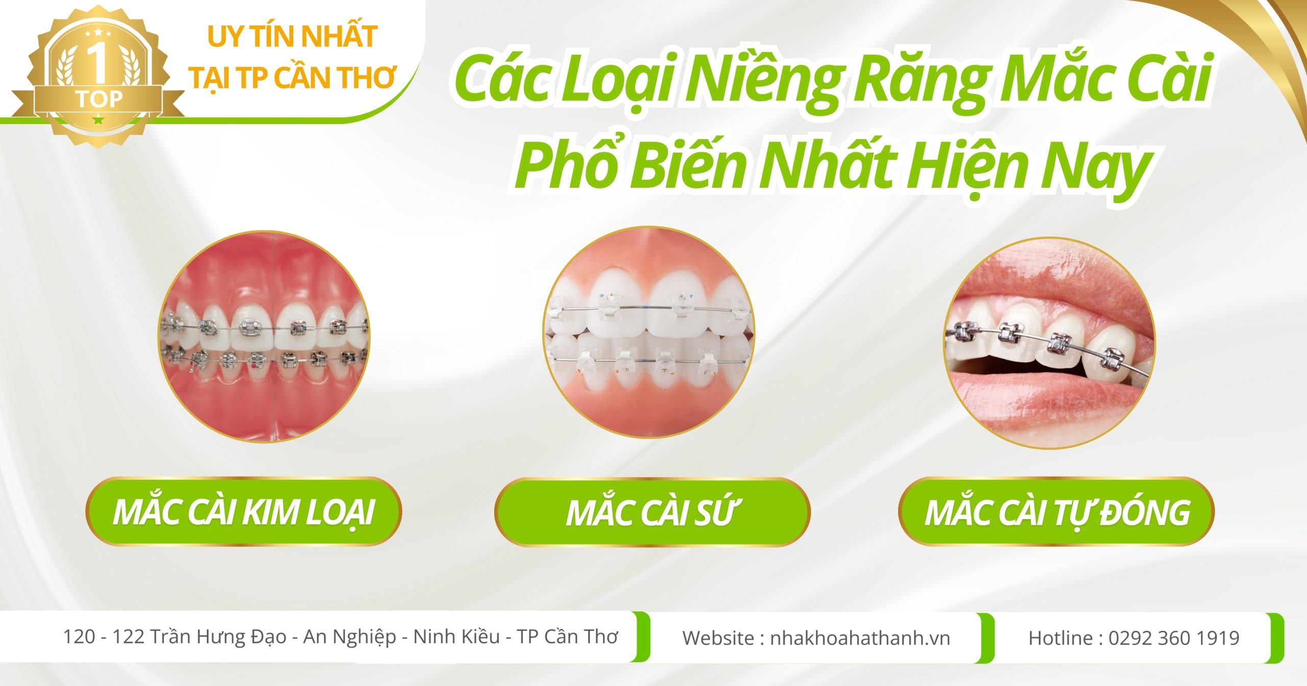 niềng răng mắc cài - nha khoa hà thàn tự đong cần thơ - nha khoa uy tín