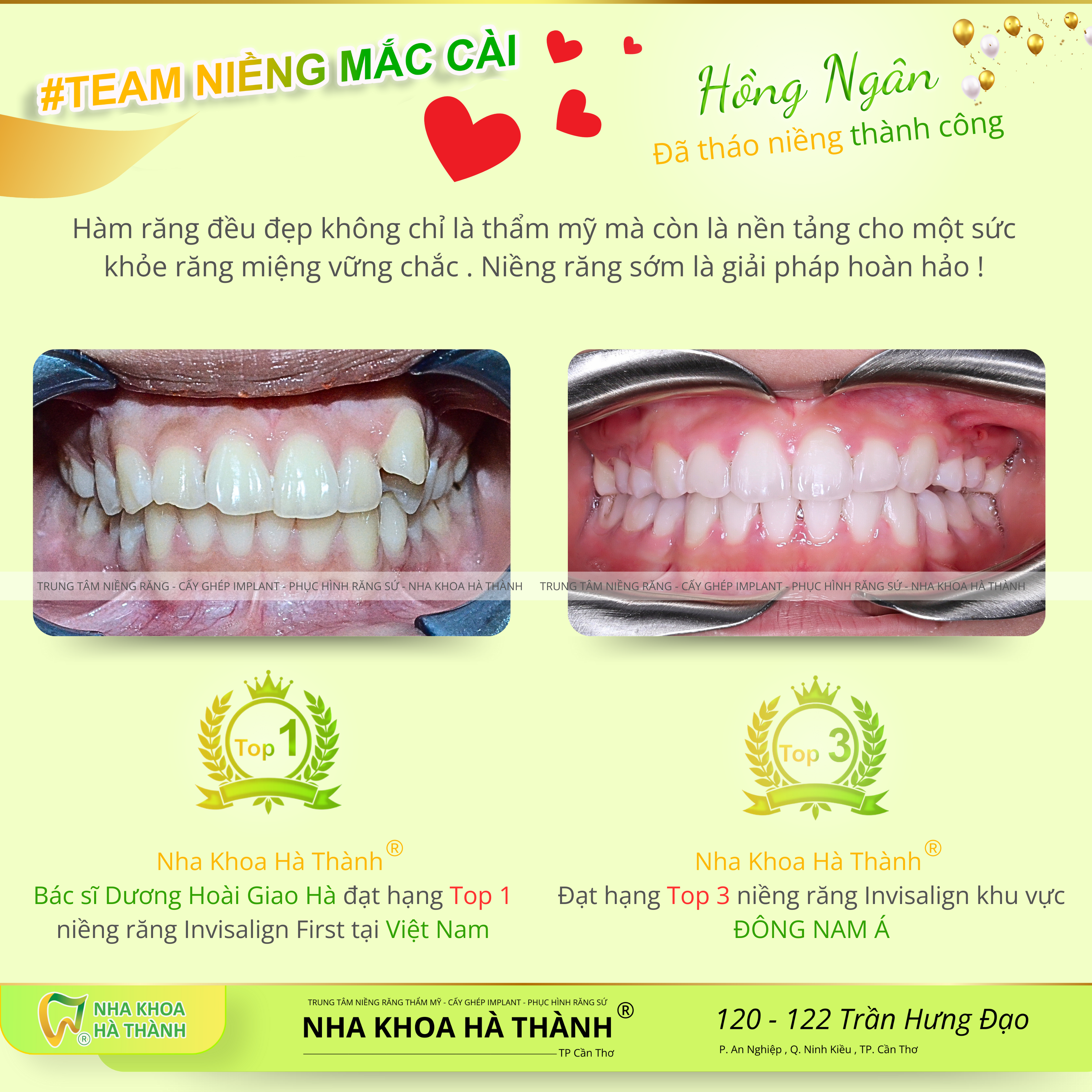 niềng răng uy tín-niềng răng trả góp 0% lãi suất-nha khoa hà thành cần thơ 