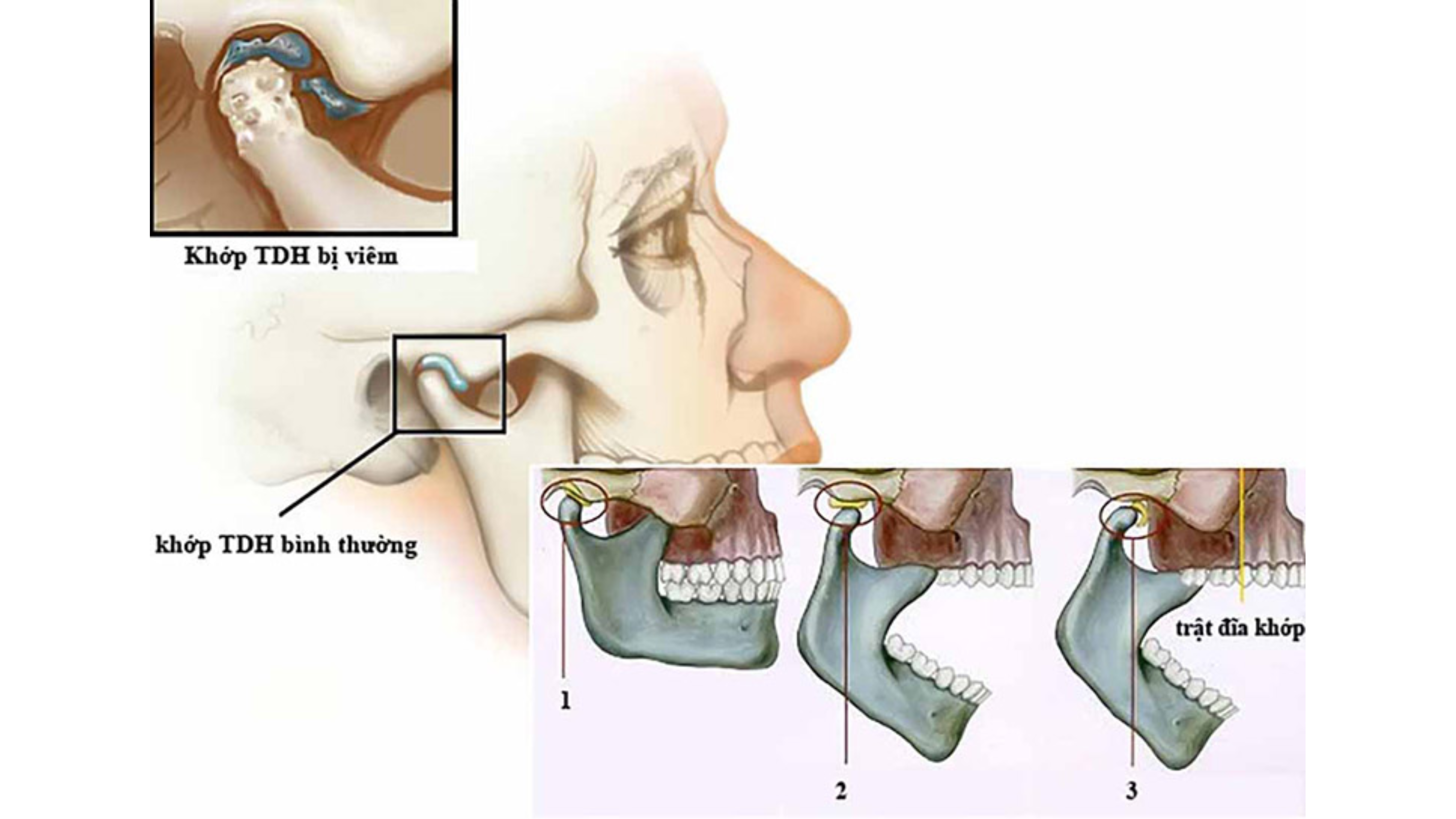 rối loạn khớp thái dương hàm-nha khoa uy tín điều trị khớp thái dương hàm ở Cần Thơ-nha khoa hà thành