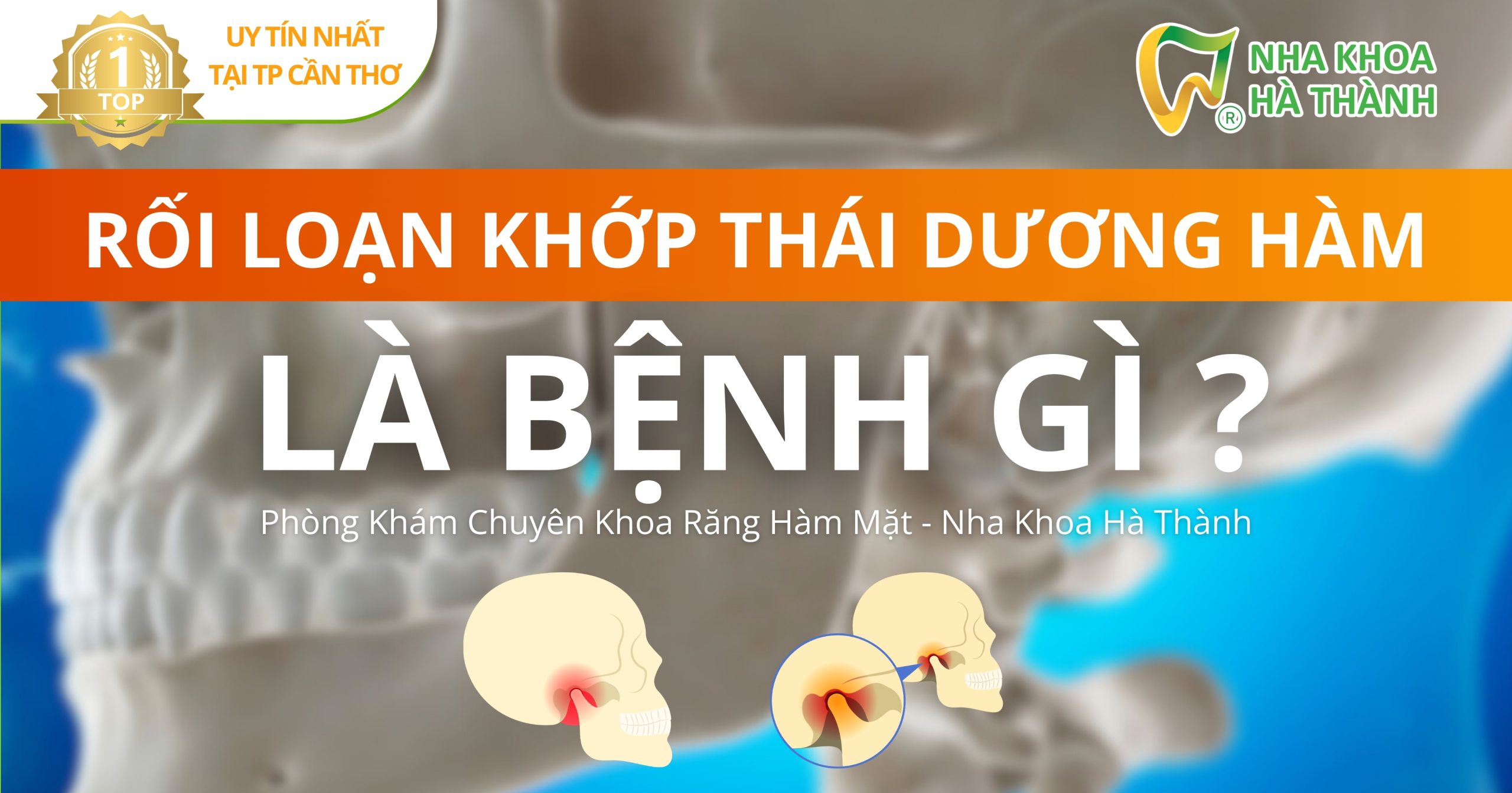 rối loạn khớp thái dương hàm-nha khoa uy tín điều trị khớp thái dương hàm ở Cần Thơ