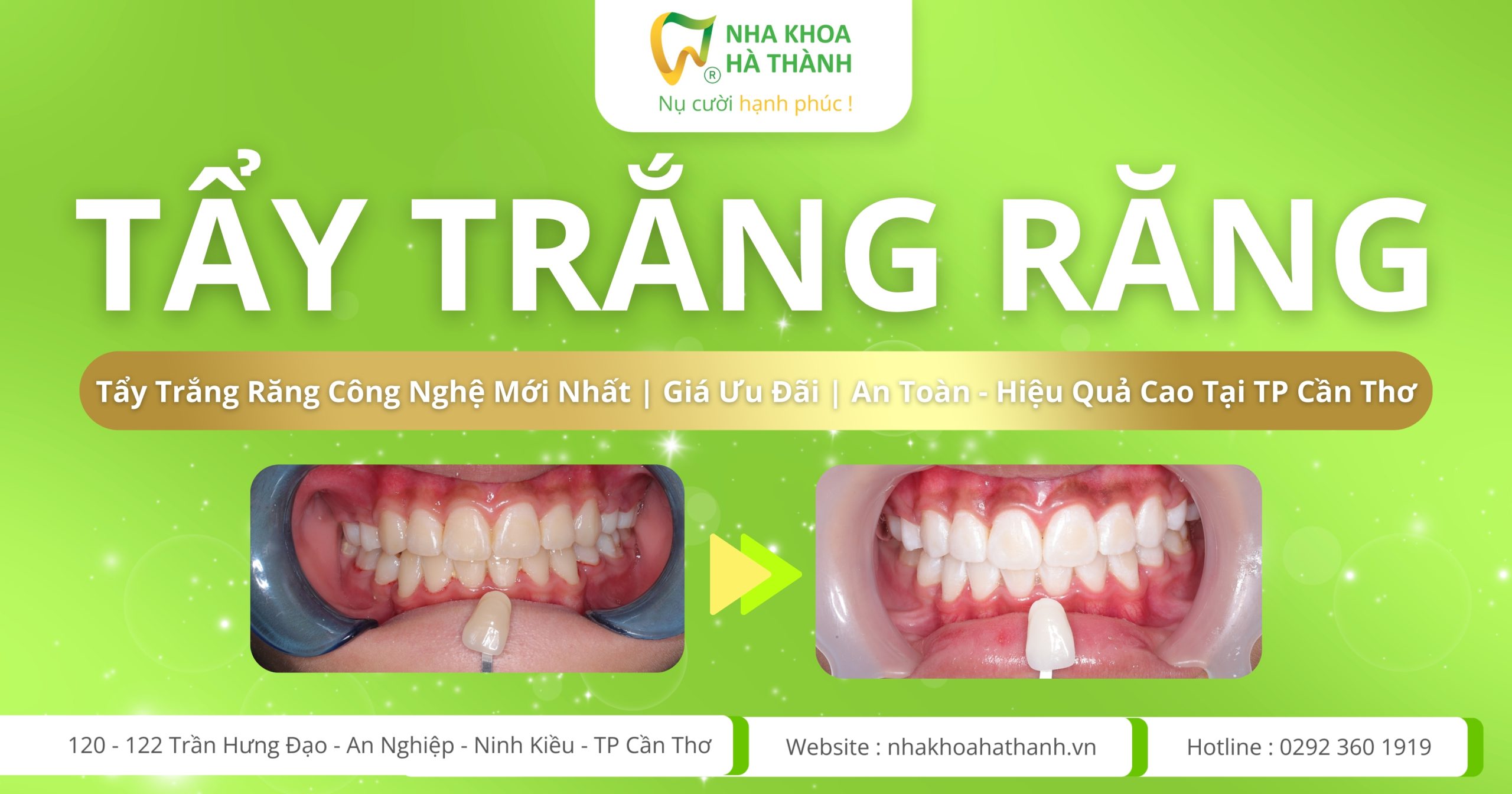 tẩy trắng răng-làm trắng răng cần thơ 