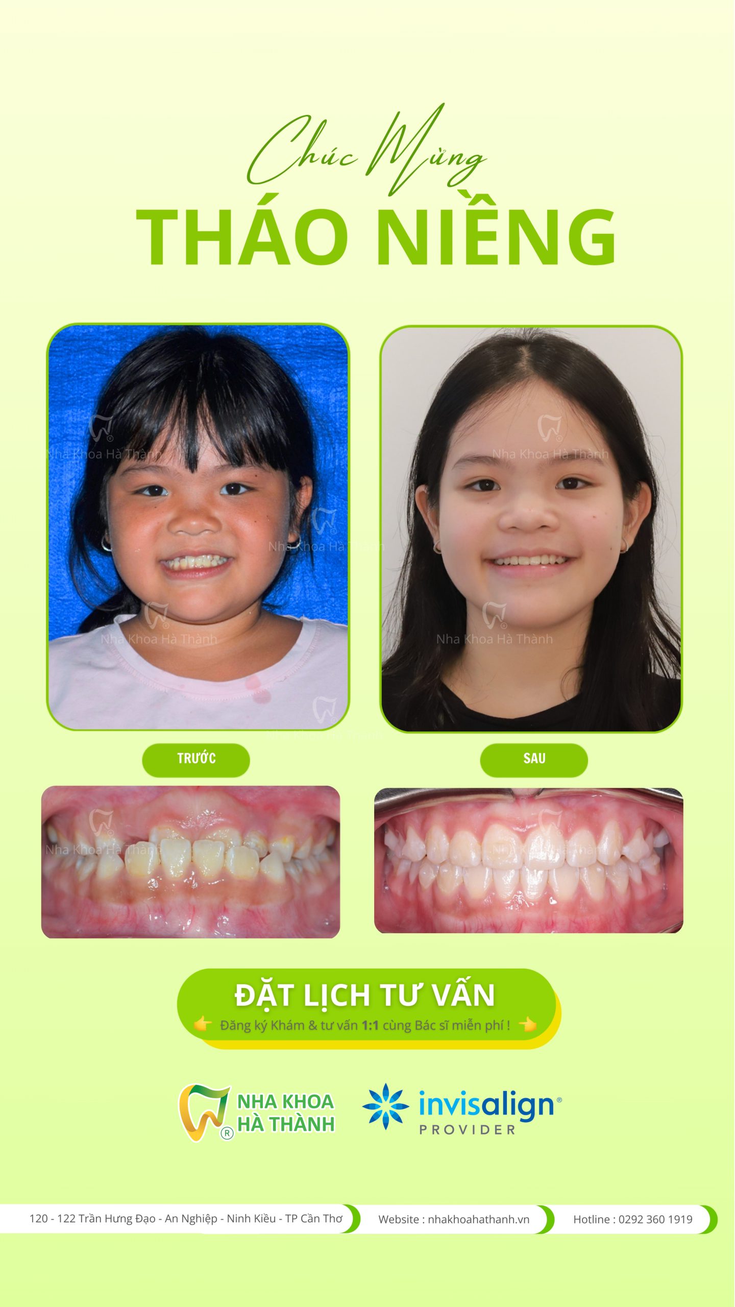 invisalign-first-nieng-rang-khay-trong-suot-invisalign-tre-em-nha-khoa-ha-thanh-can-tho-nha-khoa-uy-tin