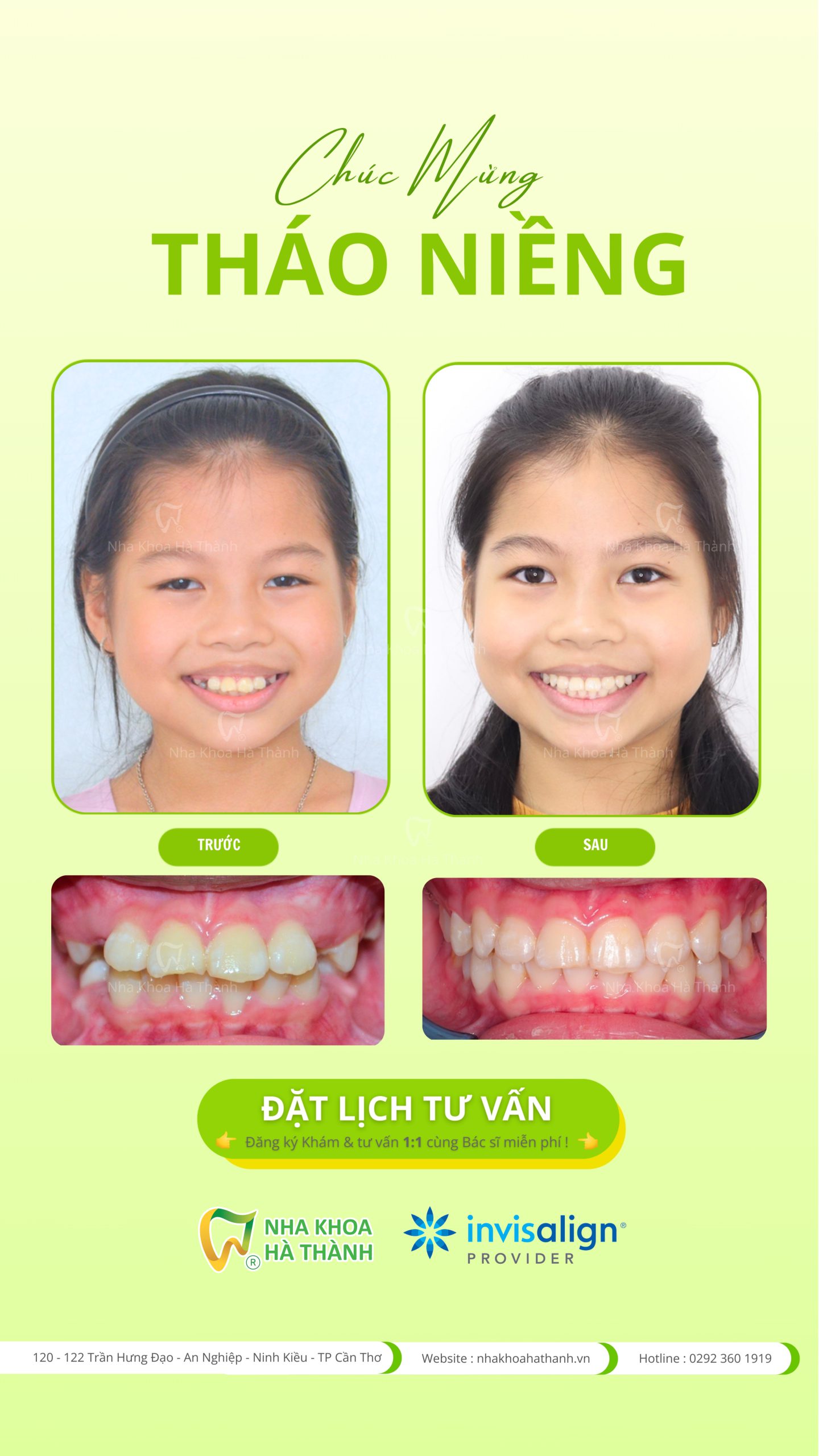 invisalign-first-nieng-rang-khay-trong-suot-invisalign-tre-em-nha-khoa-ha-thanh-can-tho-nha-khoa-uy-tin