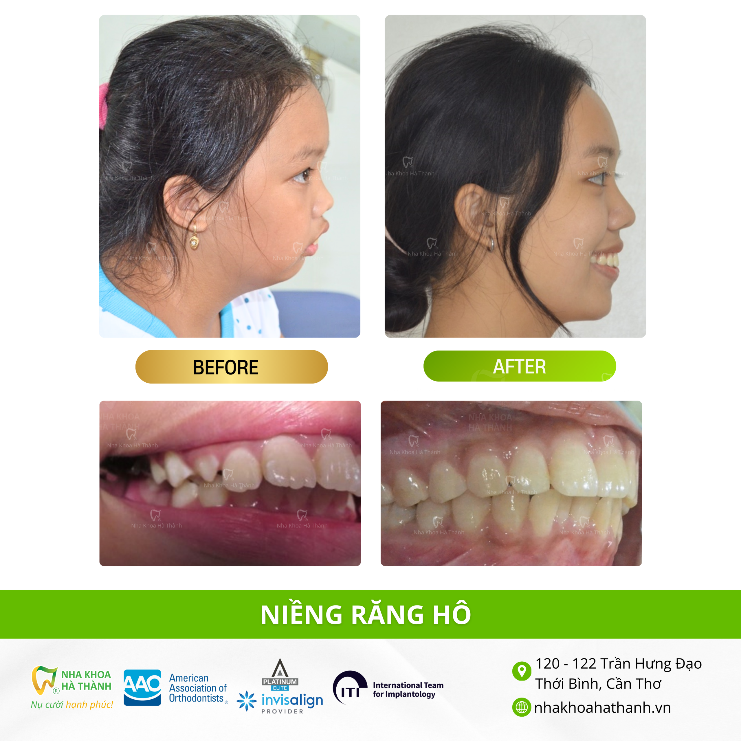 niềng-răng-hô-trường-hợp-niềng-răng-nhakhoa-hà-thành-nha-khoa-uy-tin-cần-thơ-bác-sĩ-giao-hà