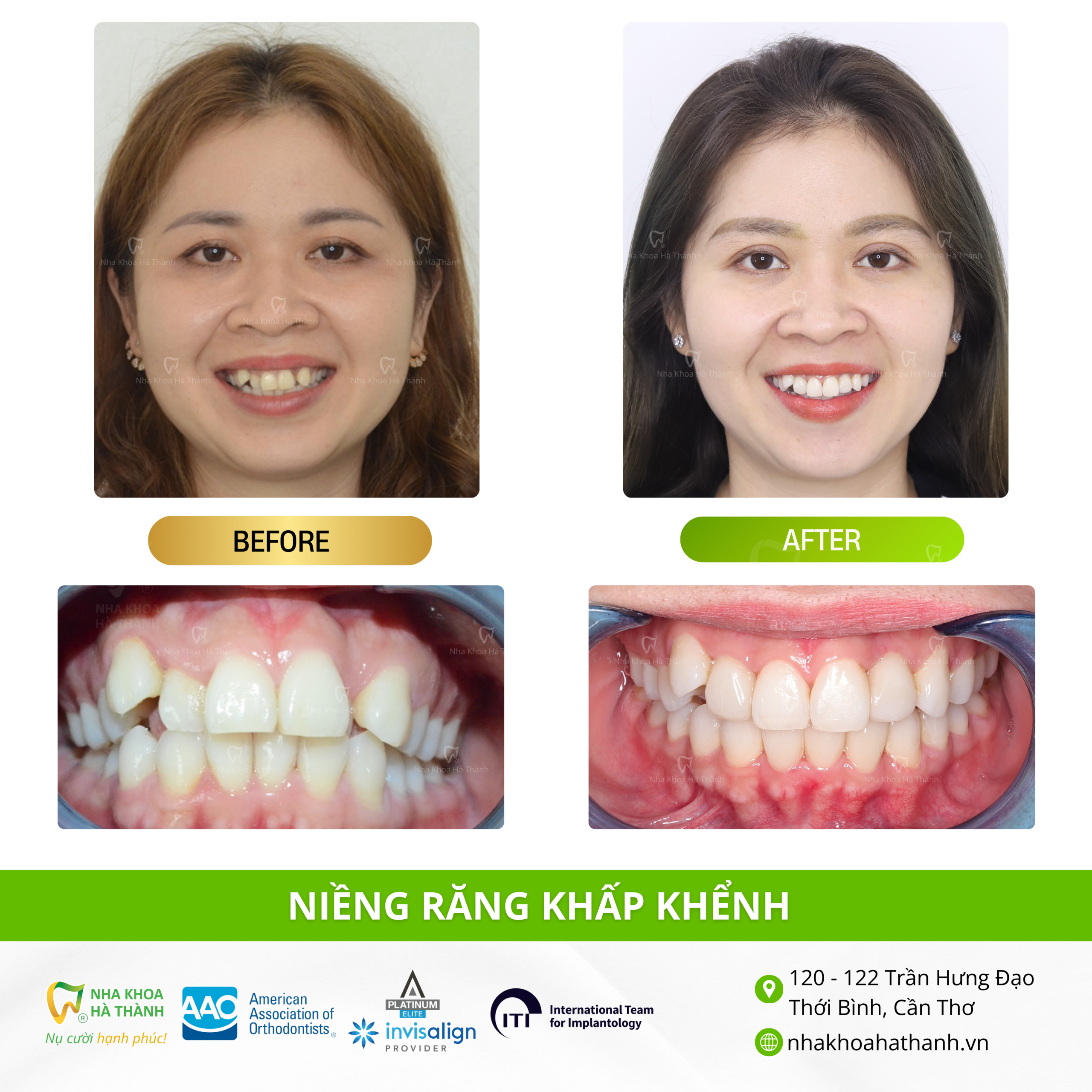 nieng-rang-khap-khenh-truong-hop-nieng-rang-nhakhoa-ha-thanh-nha-khoa-uy-tin-can-tho-bac-si-giao-ha