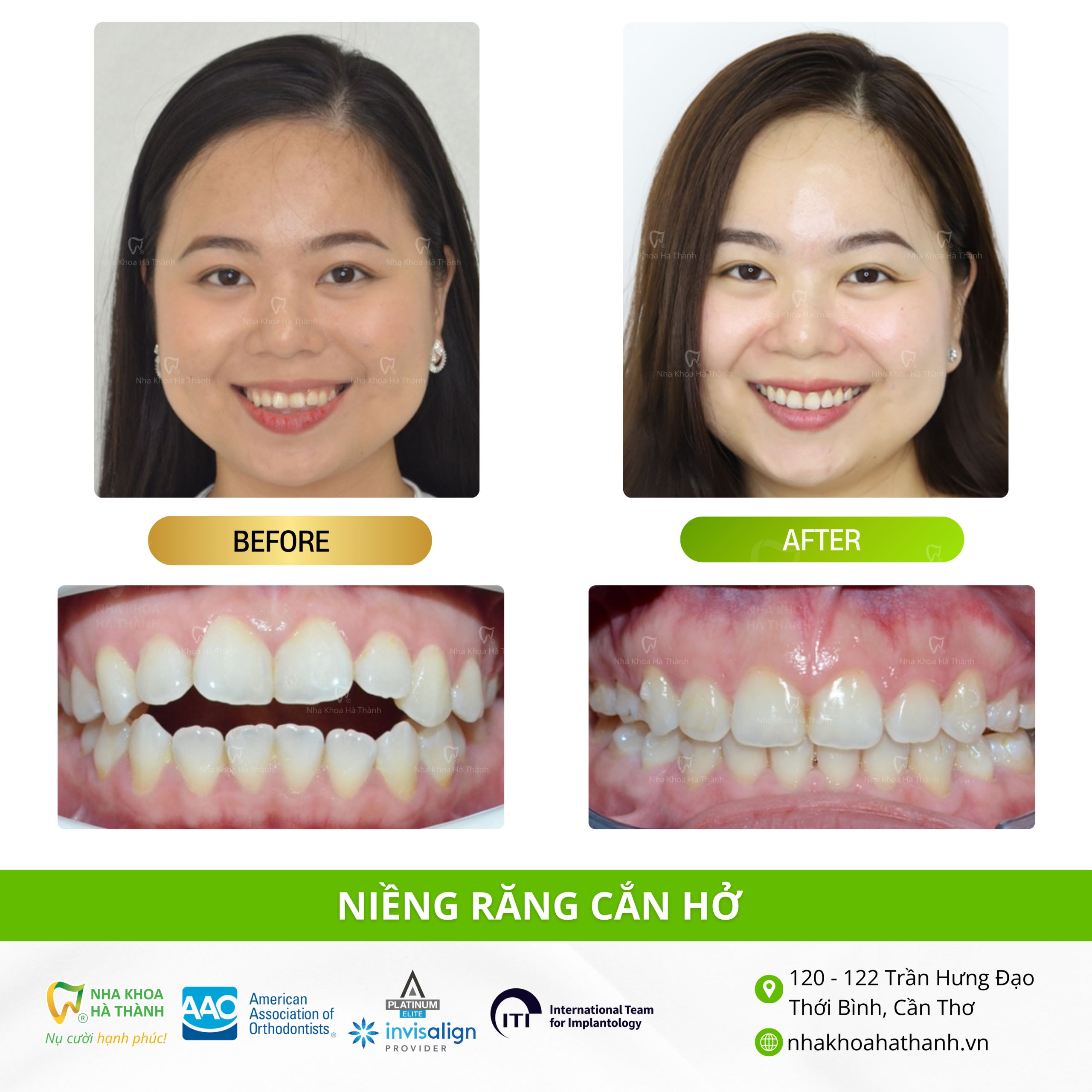 nieng-rang-khop-can-ho-truong-hop-nieng-rang-nhakhoa-ha-thanh-nha-khoa-uy-tin-can-tho-bac-si-giao-ha