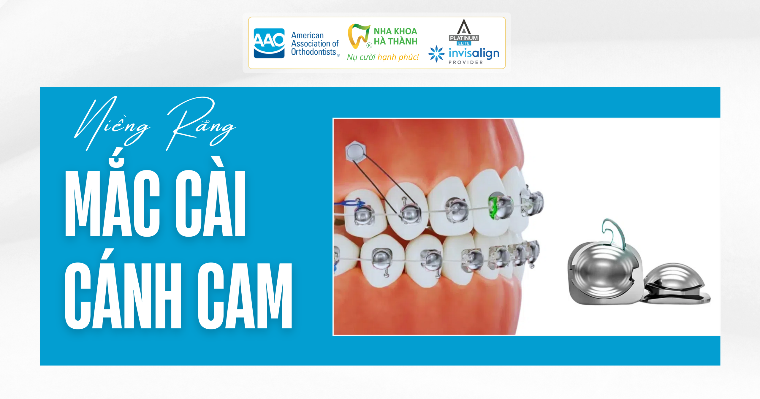 niềng-răng-mắc-cài-cánh-cam-nha-khoa-uy-tín-cần-thơ-nha-khoa-hà-thành