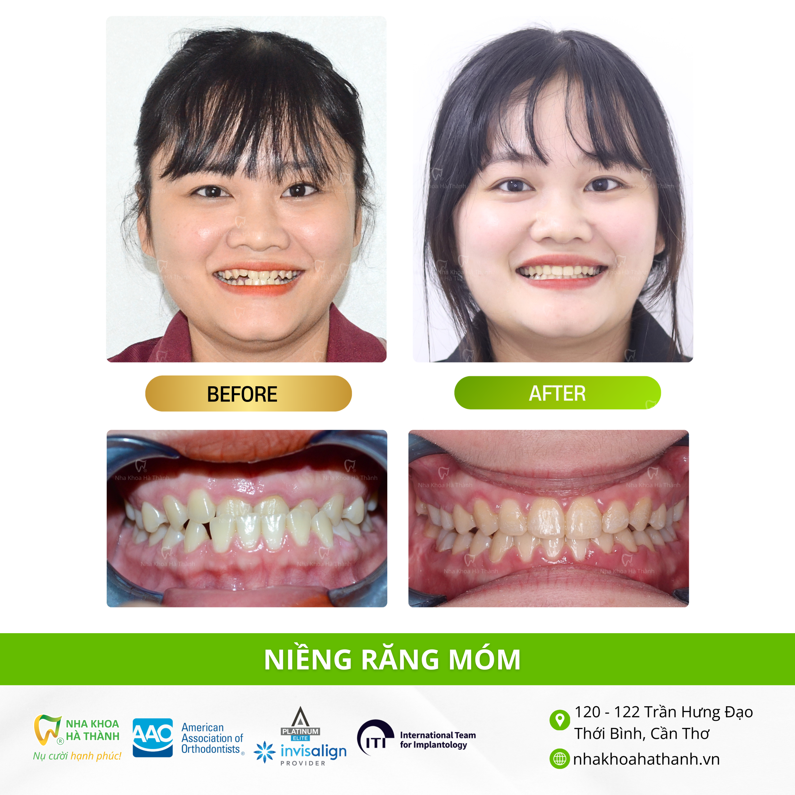 niềng-răng-móm-trường-hợp-niềng-răng-nhakhoa-hà-thành-nha-khoa-uy-tin-cần-thơ-bác-sĩ-giao-hà