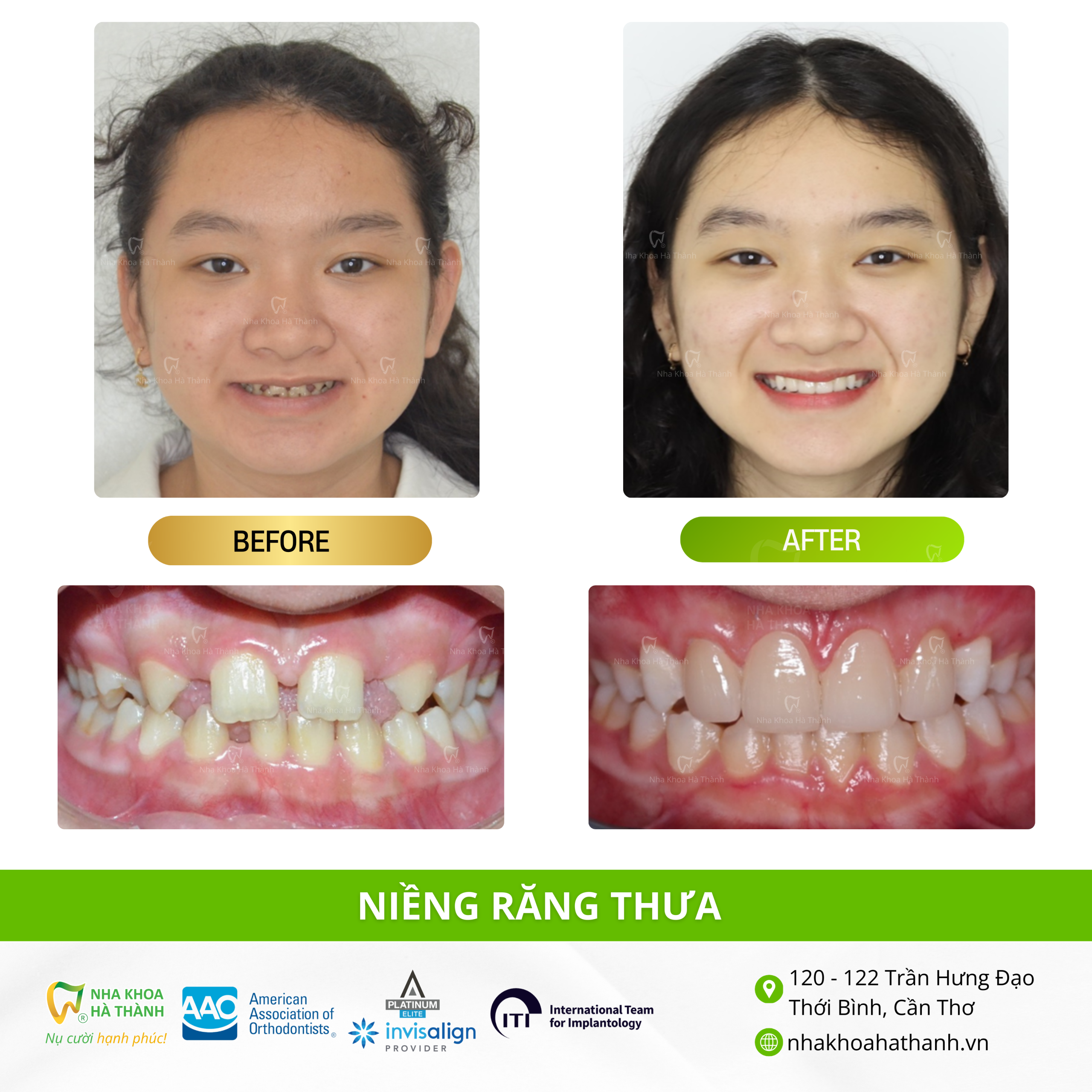 nieng-rang-thua-truong-hop-nieng-rang-nhakhoa-ha-thanh-nha-khoa-uy-tin-can-tho-bac-si-giao-ha
