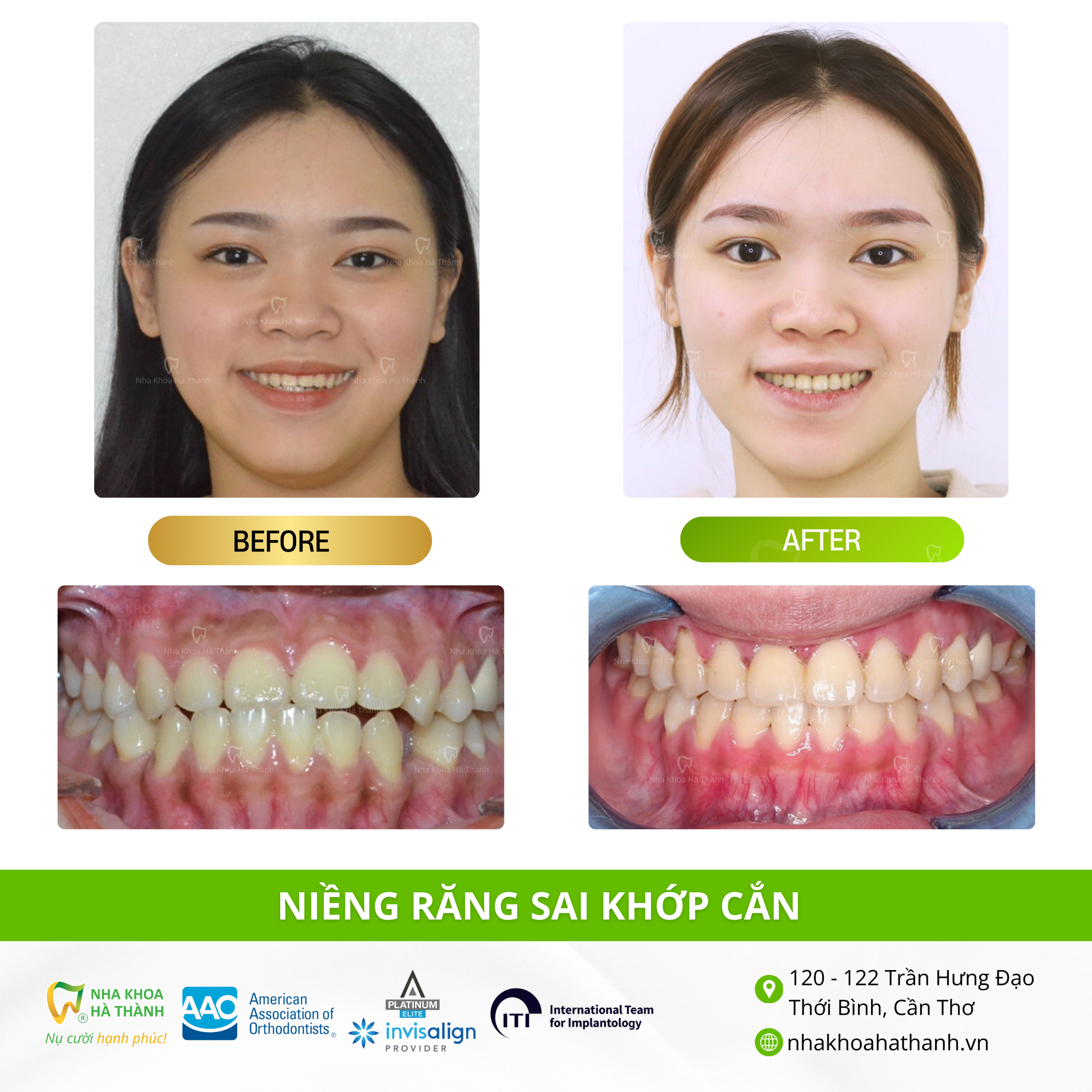 sai-khop-can-truong-hop-nieng-rang-nhakhoa-ha-thanh-nha-khoa-uy-tin-can-tho-bac-si-giao-ha
