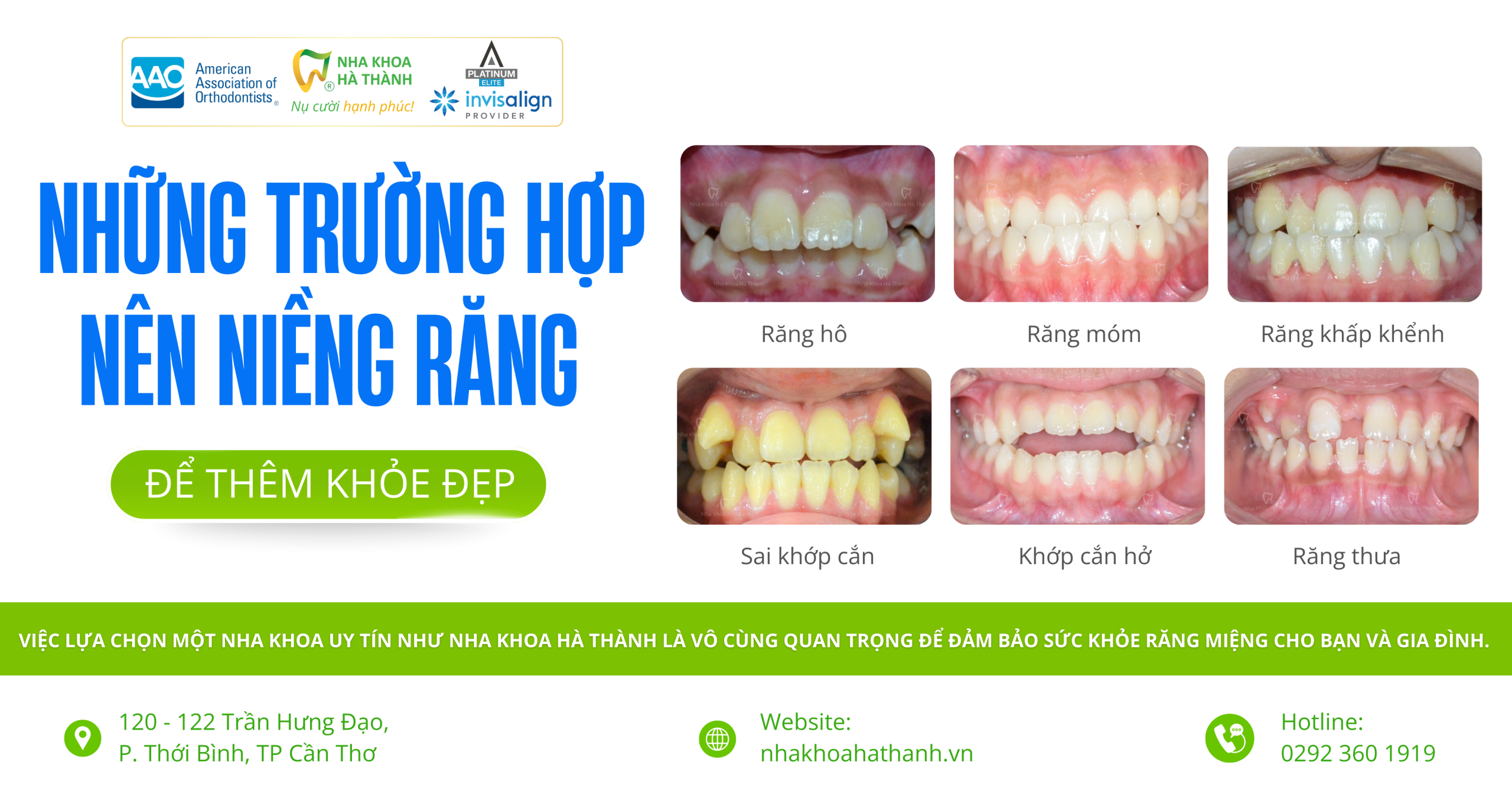 truong-hop-nieng-rang-nhakhoa-ha-thanh-nha-khoa-uy-tin-can-tho-bac-si-giao-ha