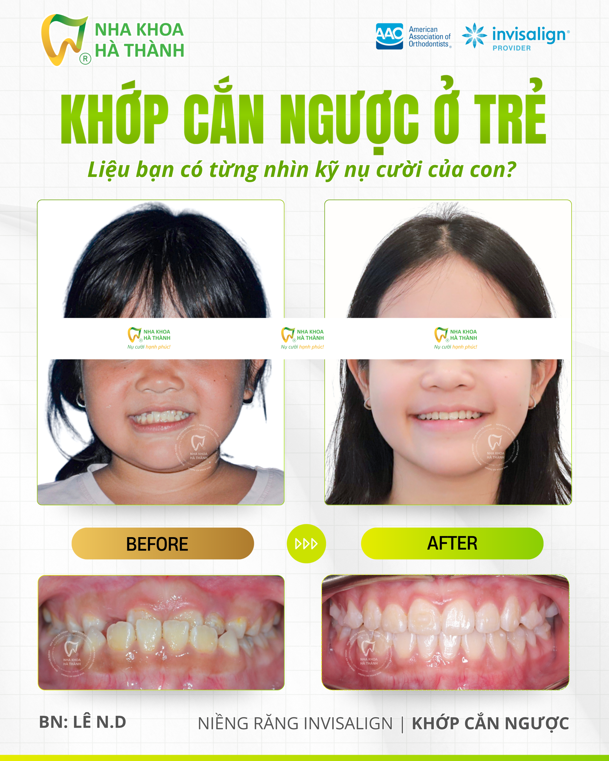 Danh-hiệu-Invisalign-Platinum-Elite-là-gì-niềng-khay-trong-suot-nha-khoa-ha-thanh-can-tho