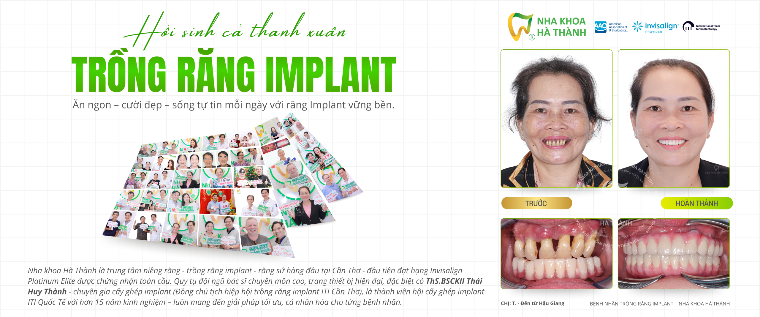trong-rang-implant-uy-tin-can-tho-nha-khoa-ha-thanh