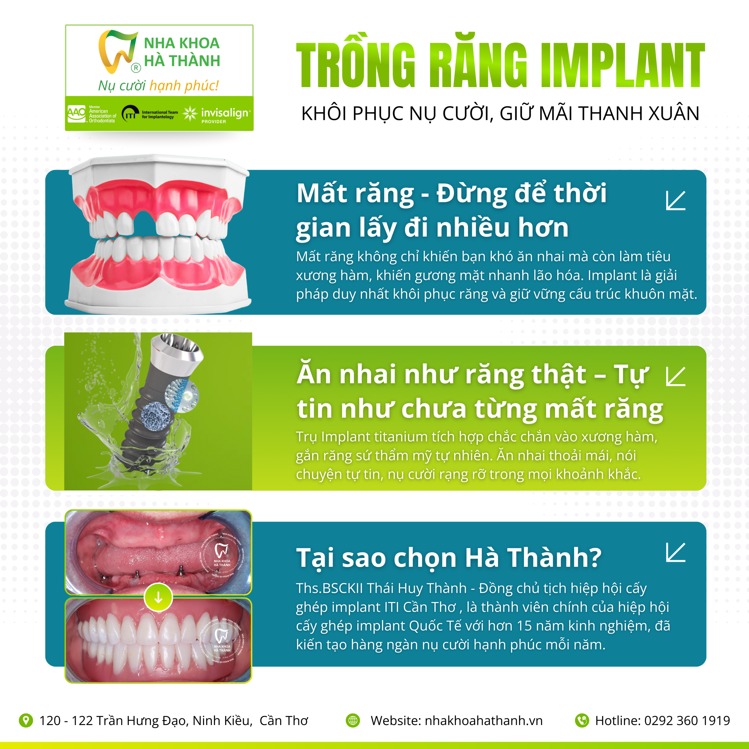 trồng-răng-implant-cấy-ghép-implant-nha-khoa-uy-tin-can-tho-nha-khoa-ha-thanh-bác-si-huy-thanh