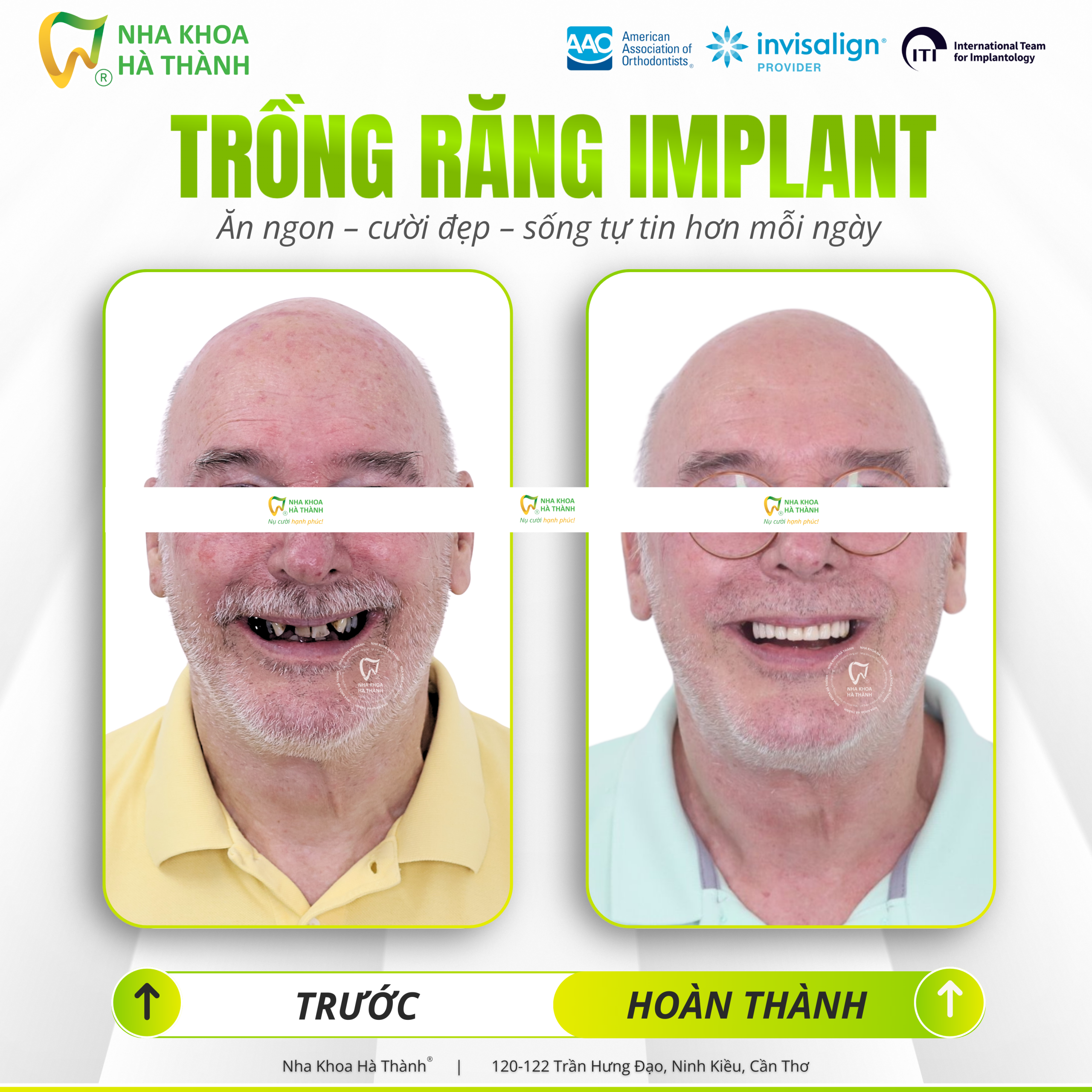 trồng-răng-implant-cấy-ghép-implant-nha-khoa-uy-tin-can-tho-nha-khoa-ha-thanh-bác-si-huy-thanh