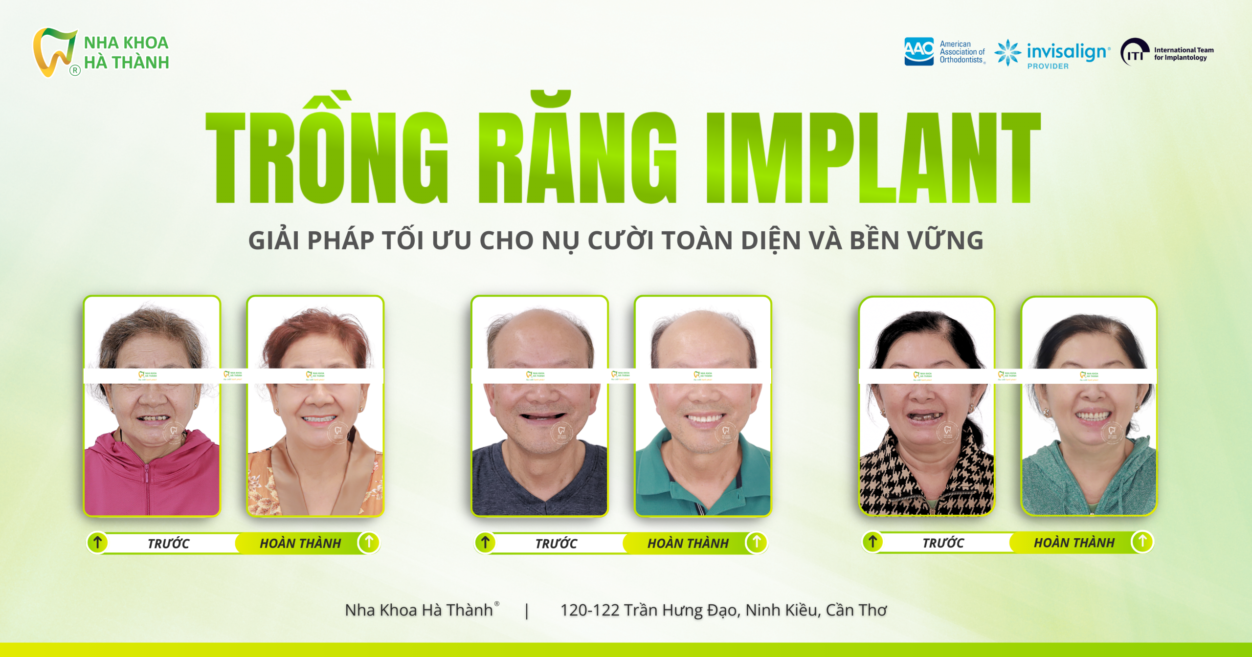 trồng-răng-implant-cấy-ghép-implant-nha-khoa-uy-tin-can-tho-nha-khoa-ha-thanh-bác-si-huy-thanh