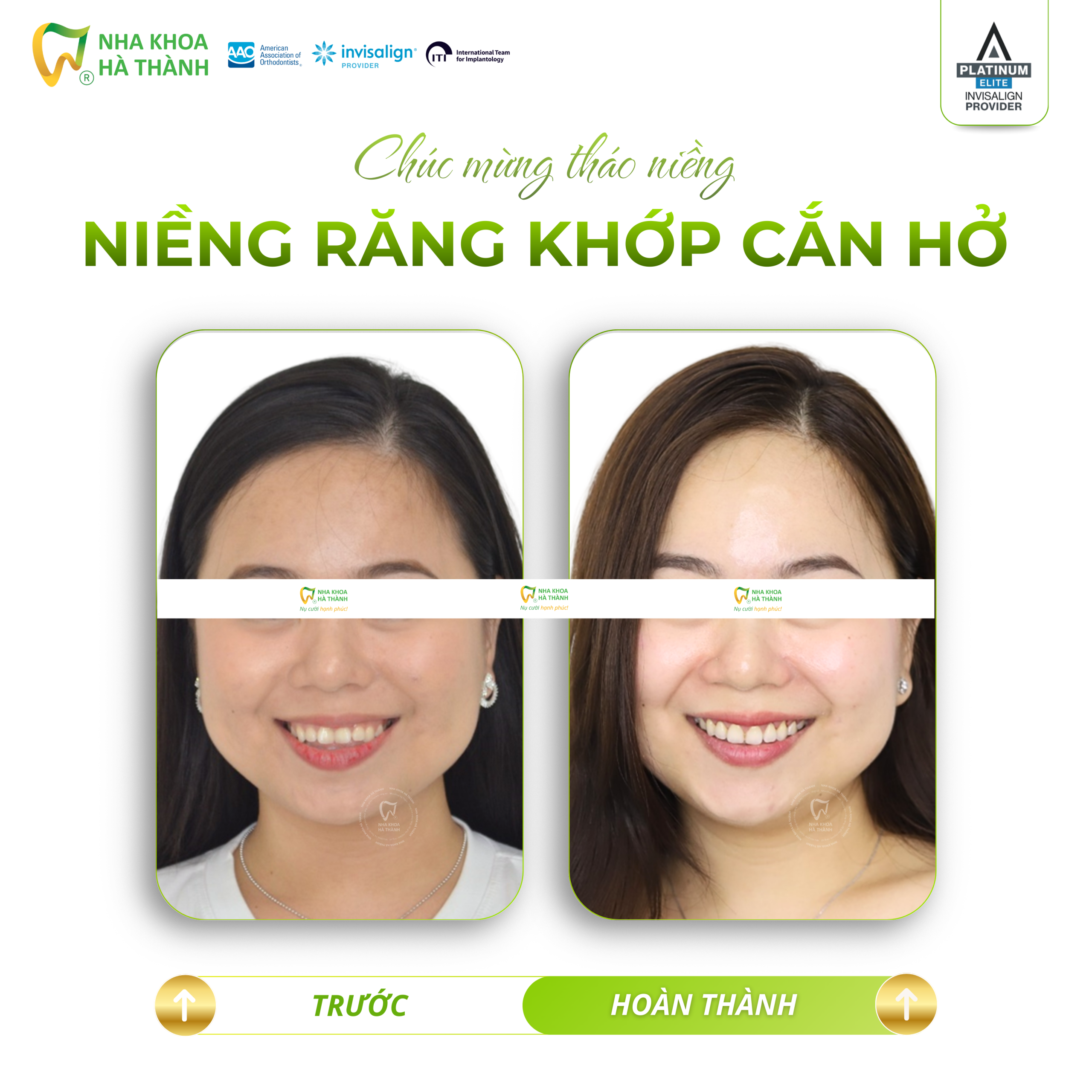 Niềng-răng-invisalign-Hà-Thành-nieng-rang-khay-trong-suot-invisalign-nha-khoa-uy-tin-can-tho1