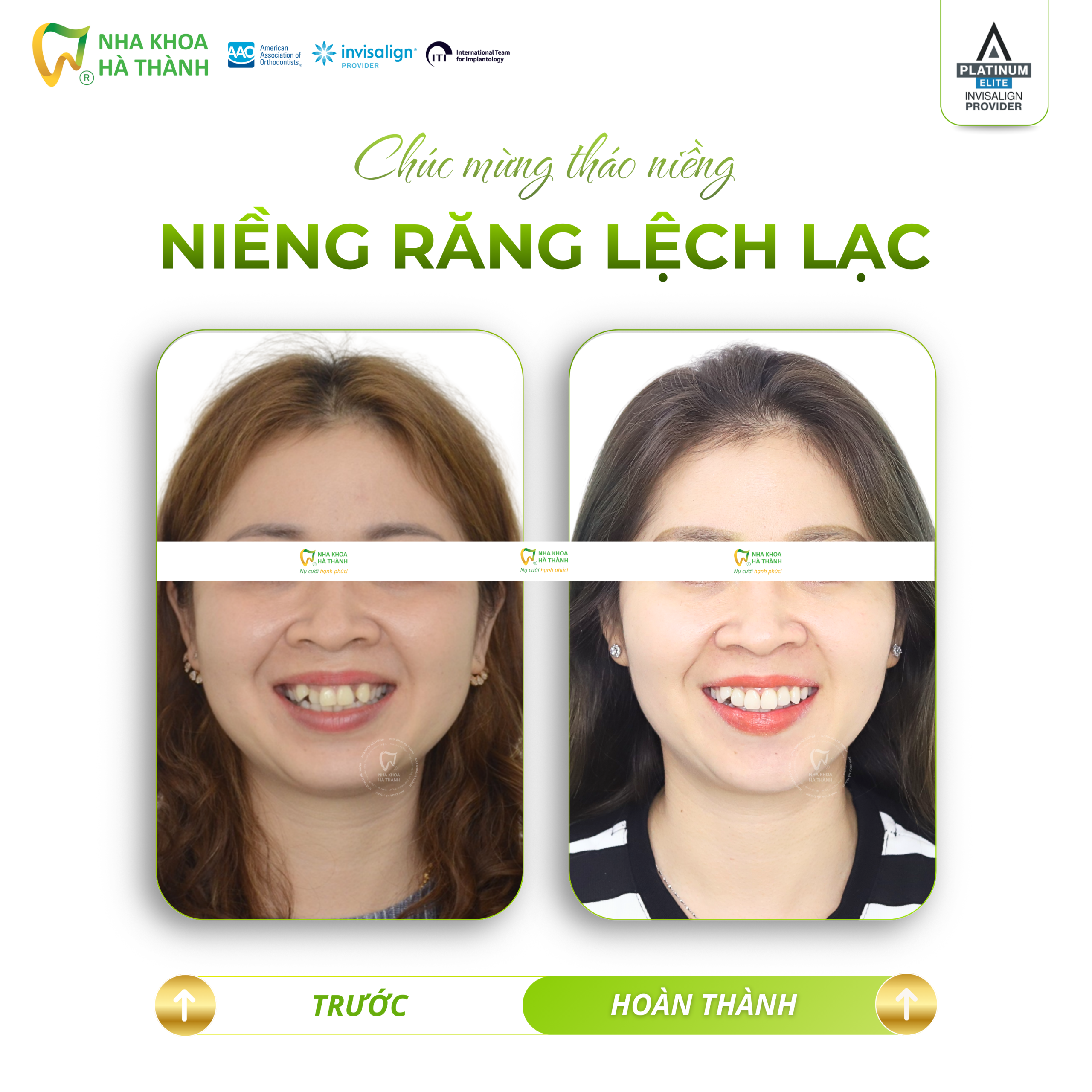Niềng-răng-invisalign-Hà-Thành-nieng-rang-khay-trong-suot-invisalign-nha-khoa-uy-tin-can-tho