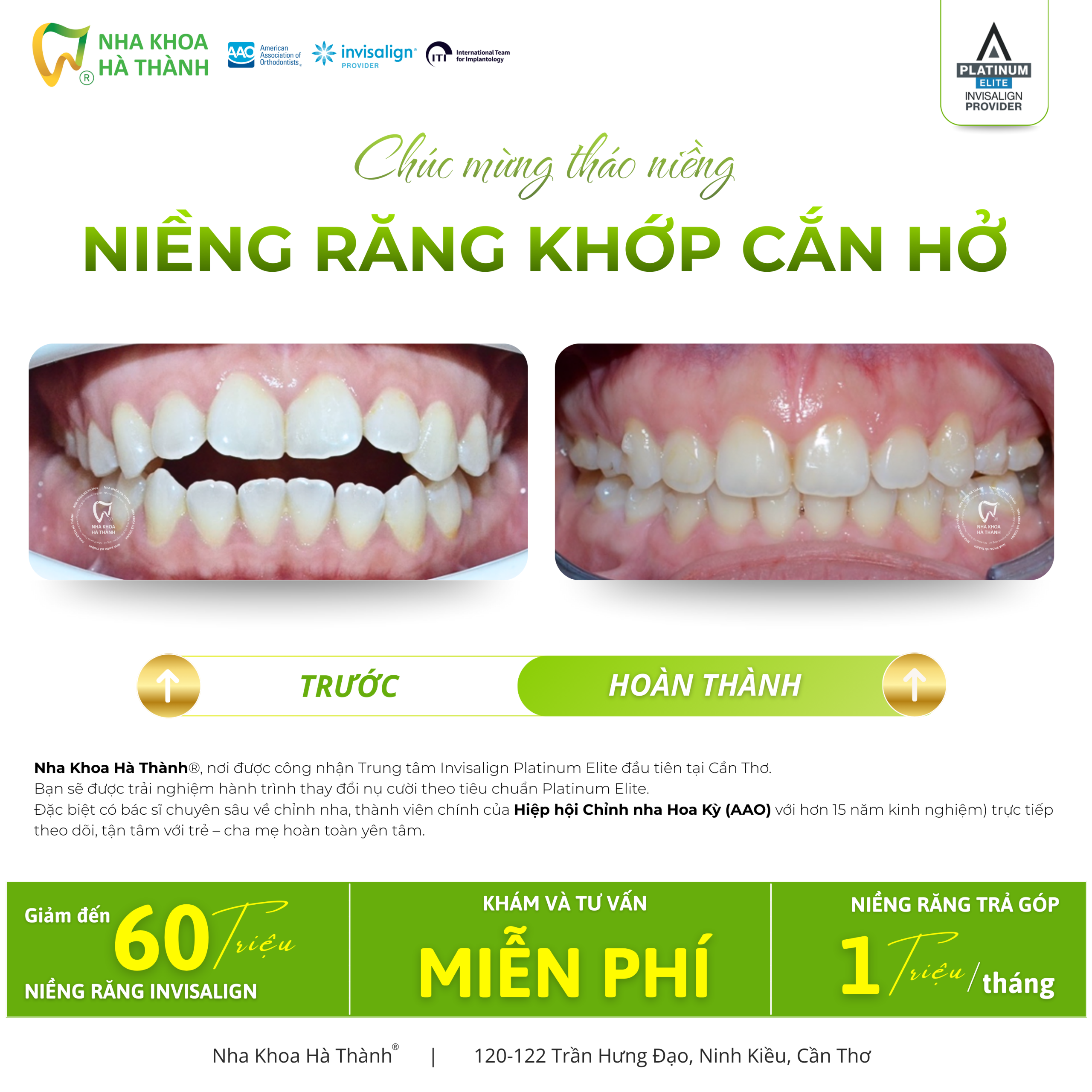 Niềng-răng-invisalign-Hà-Thành-nieng-rang-khay-trong-suot-invisalign-nha-khoa-uy-tin-can-tho1