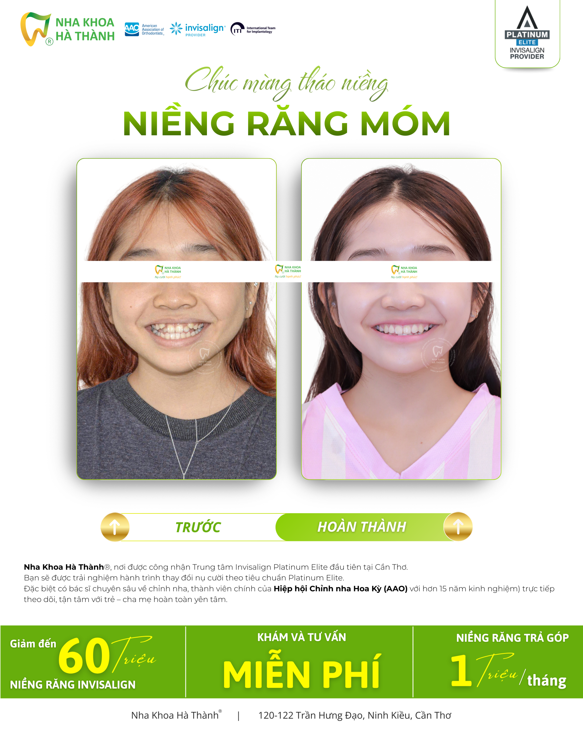 Niềng-răng-invisalign-Hà-Thành-nieng-rang-khay-trong-suot-invisalign-nha-khoa-uy-tin-can-tho
