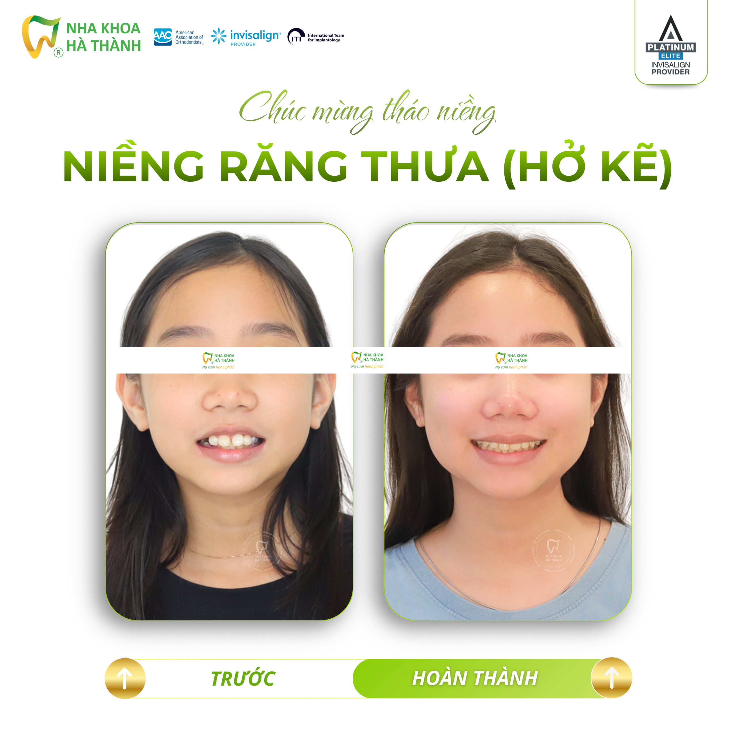 Niềng-răng-invisalign-Hà-Thành-nieng-rang-khay-trong-suot-invisalign-nha-khoa-uy-tin-can-tho2