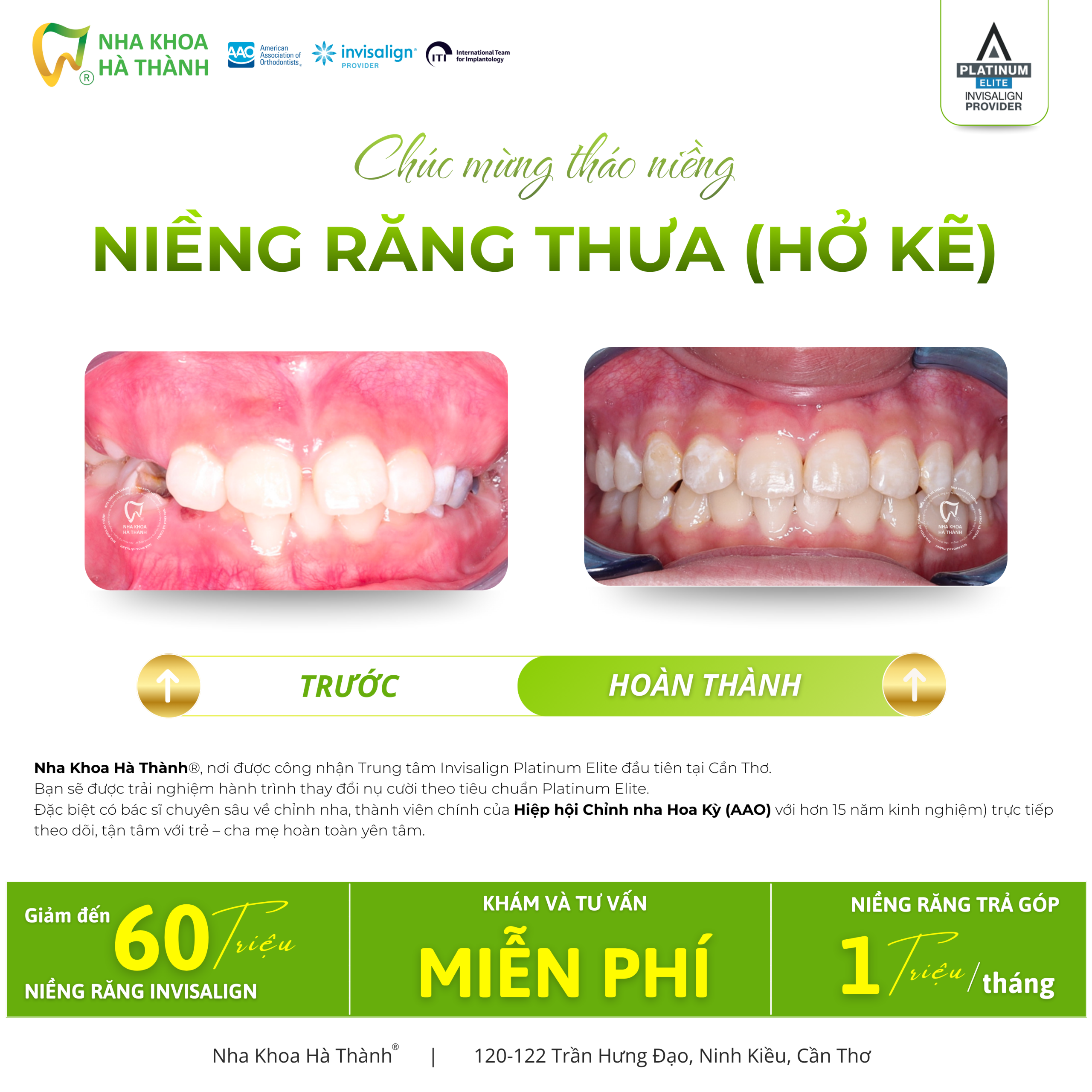 Niềng-răng-invisalign-Hà-Thành-nieng-rang-khay-trong-suot-invisalign-nha-khoa-uy-tin-can-tho5
