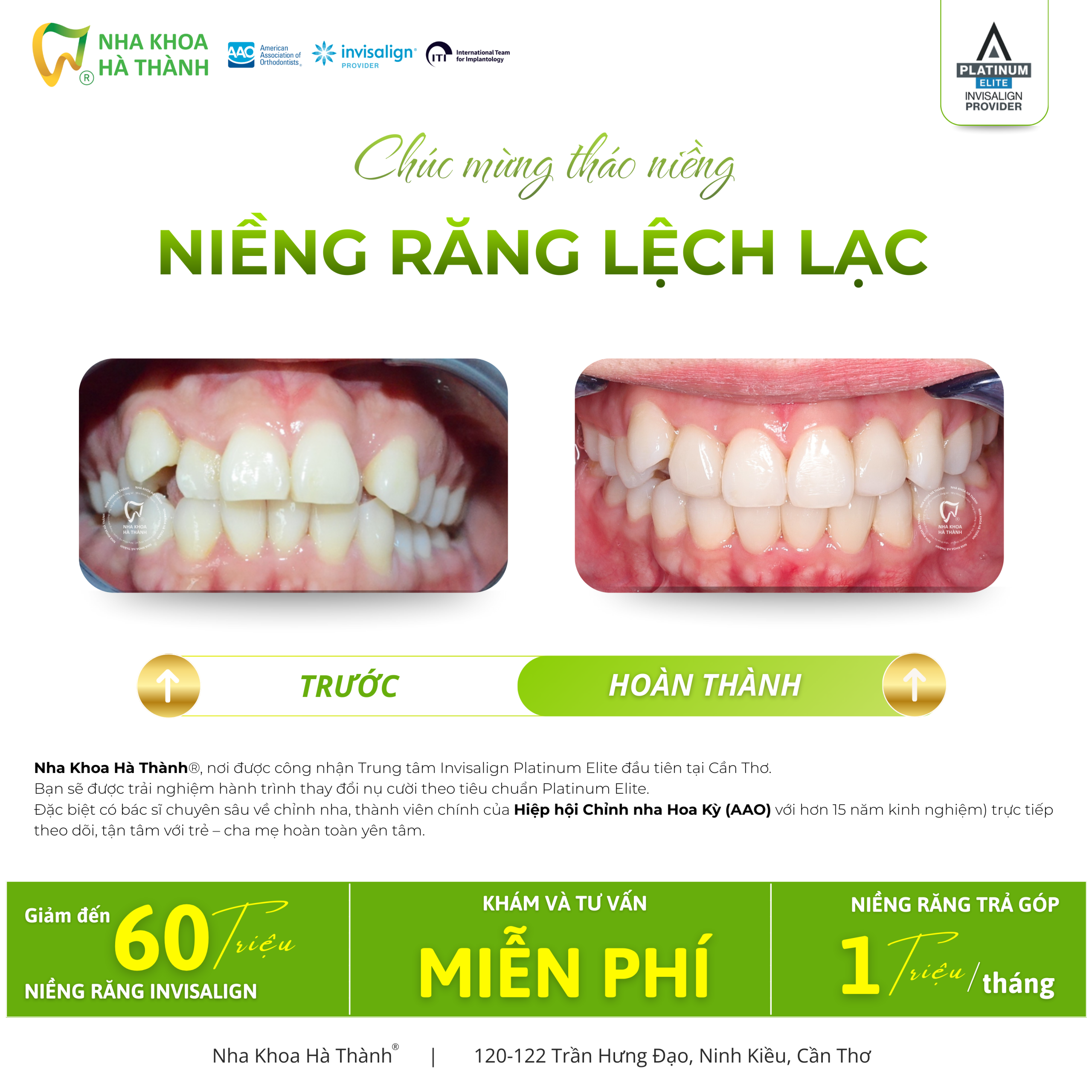 Niềng-răng-invisalign-Hà-Thành-nieng-rang-khay-trong-suot-invisalign-nha-khoa-uy-tin-can-tho6