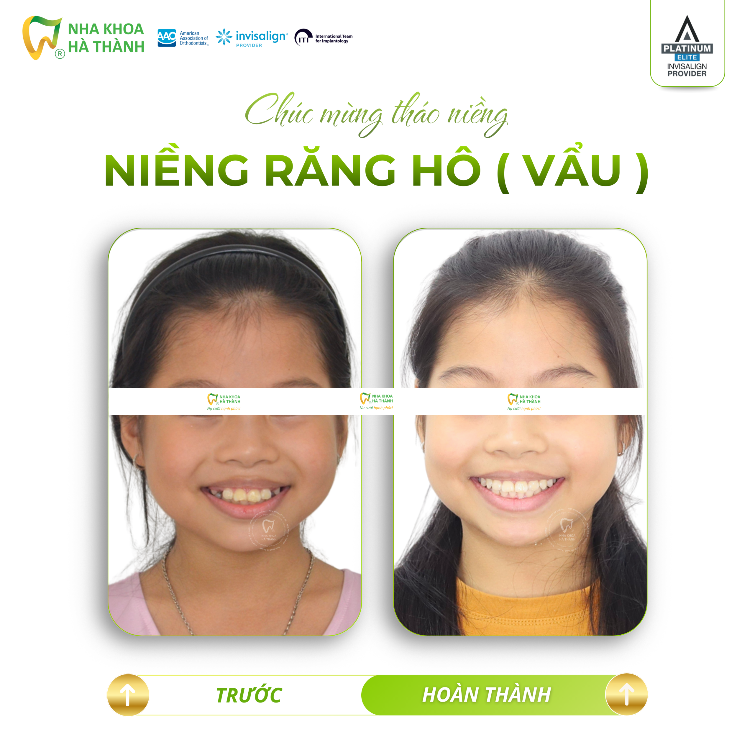 Niềng-răng-invisalign-Hà-Thành-nieng-rang-khay-trong-suot-invisalign-nha-khoa-uy-tin-can-tho