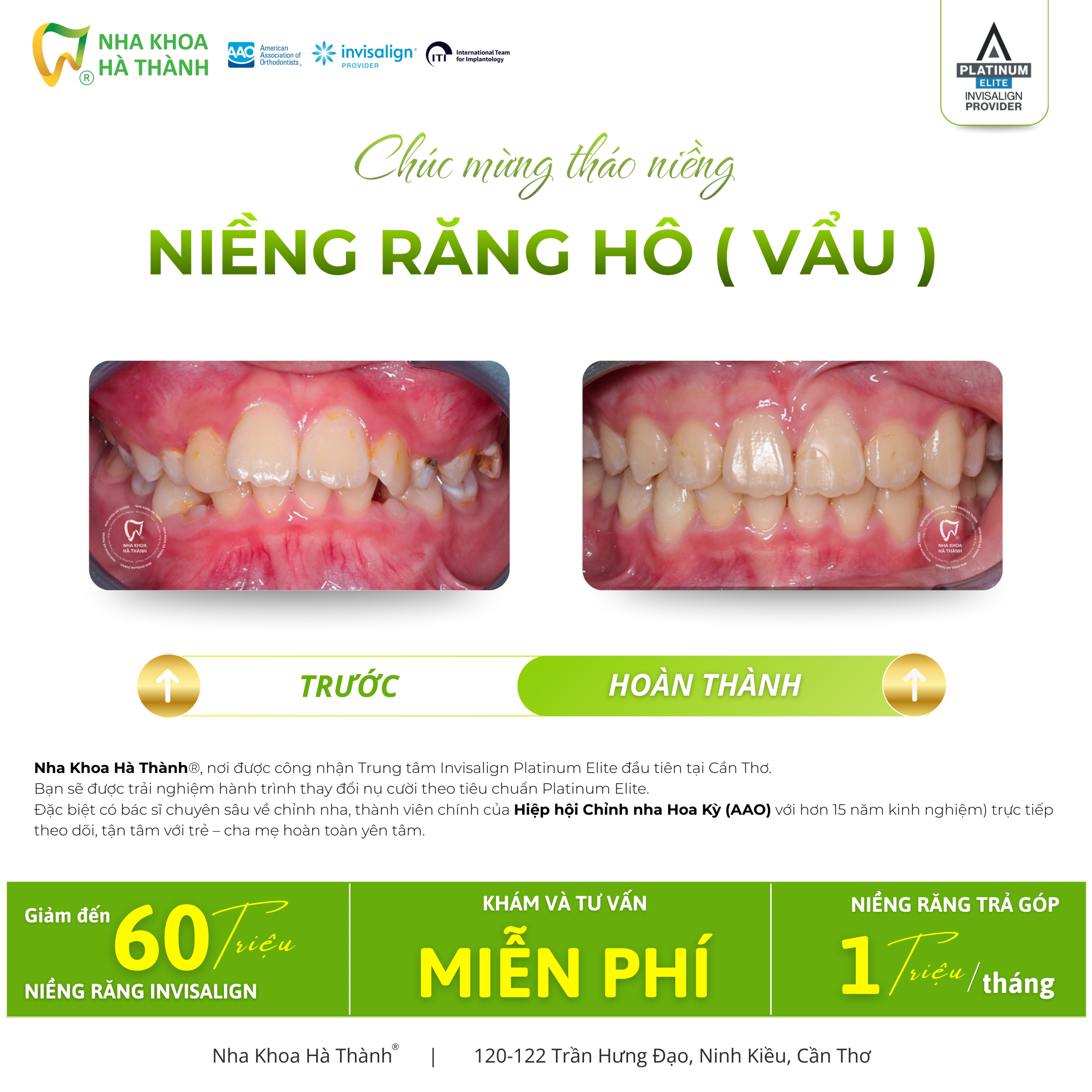 Niềng-răng-invisalign-Hà-Thành-nieng-rang-khay-trong-suot-invisalign-nha-khoa-uy-tin-can-tho8