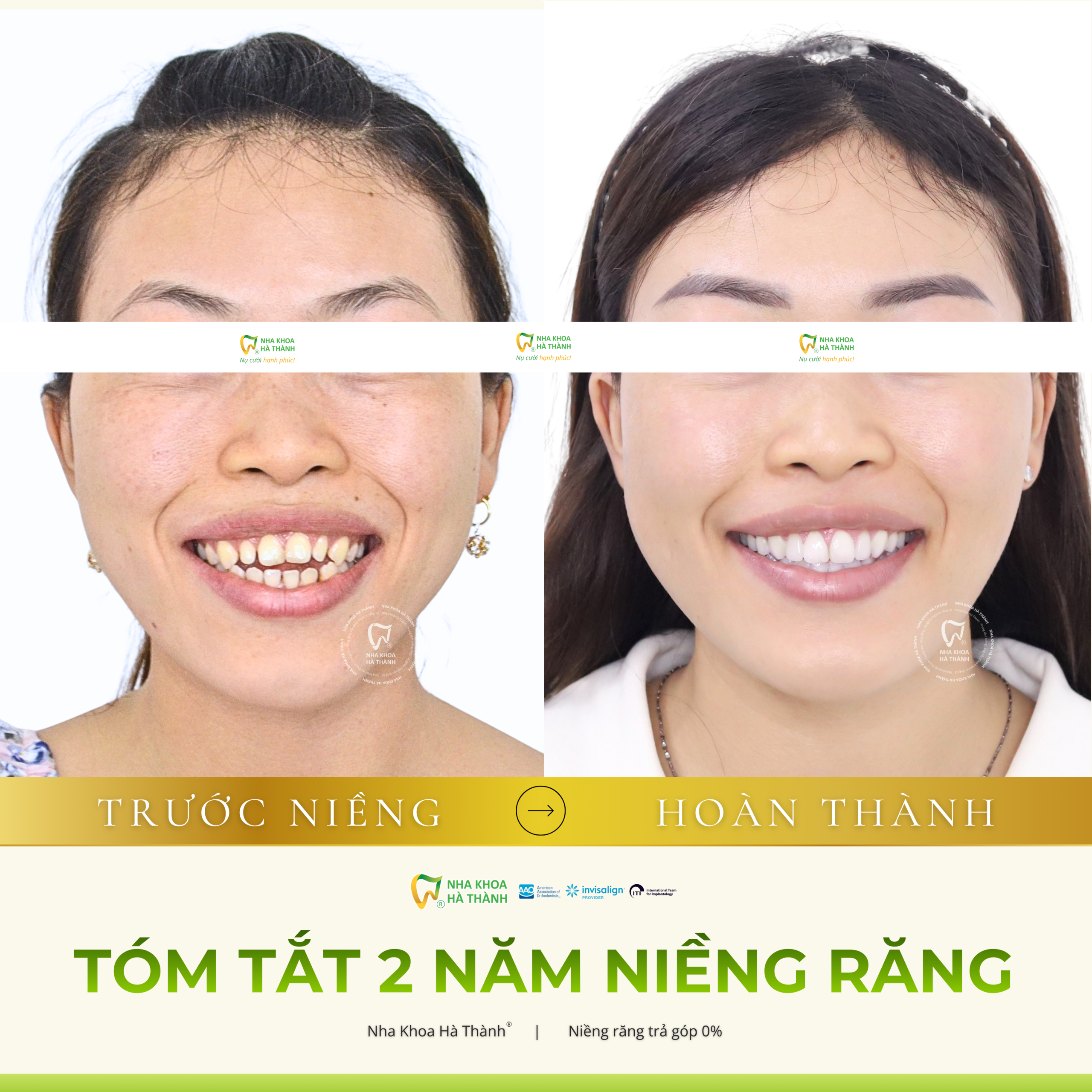 tại-sao-con-cho-thich-ham-duy-tri-hoac-khi-chinh-nha-nieng-răng-nha-khoa-ha-thanh-bac-si-dương-hoài-giao-ha-nha-khoa-uy-tín-cần-thơ