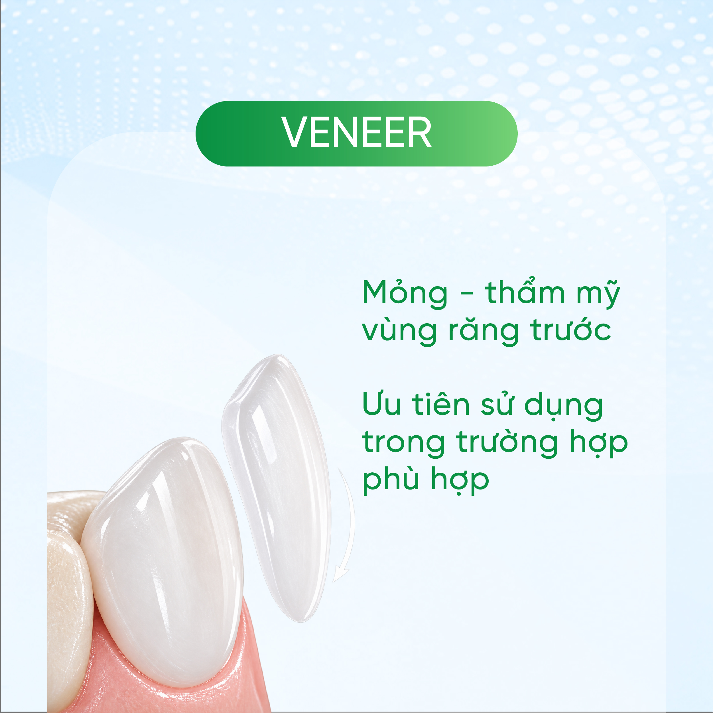 Veneer