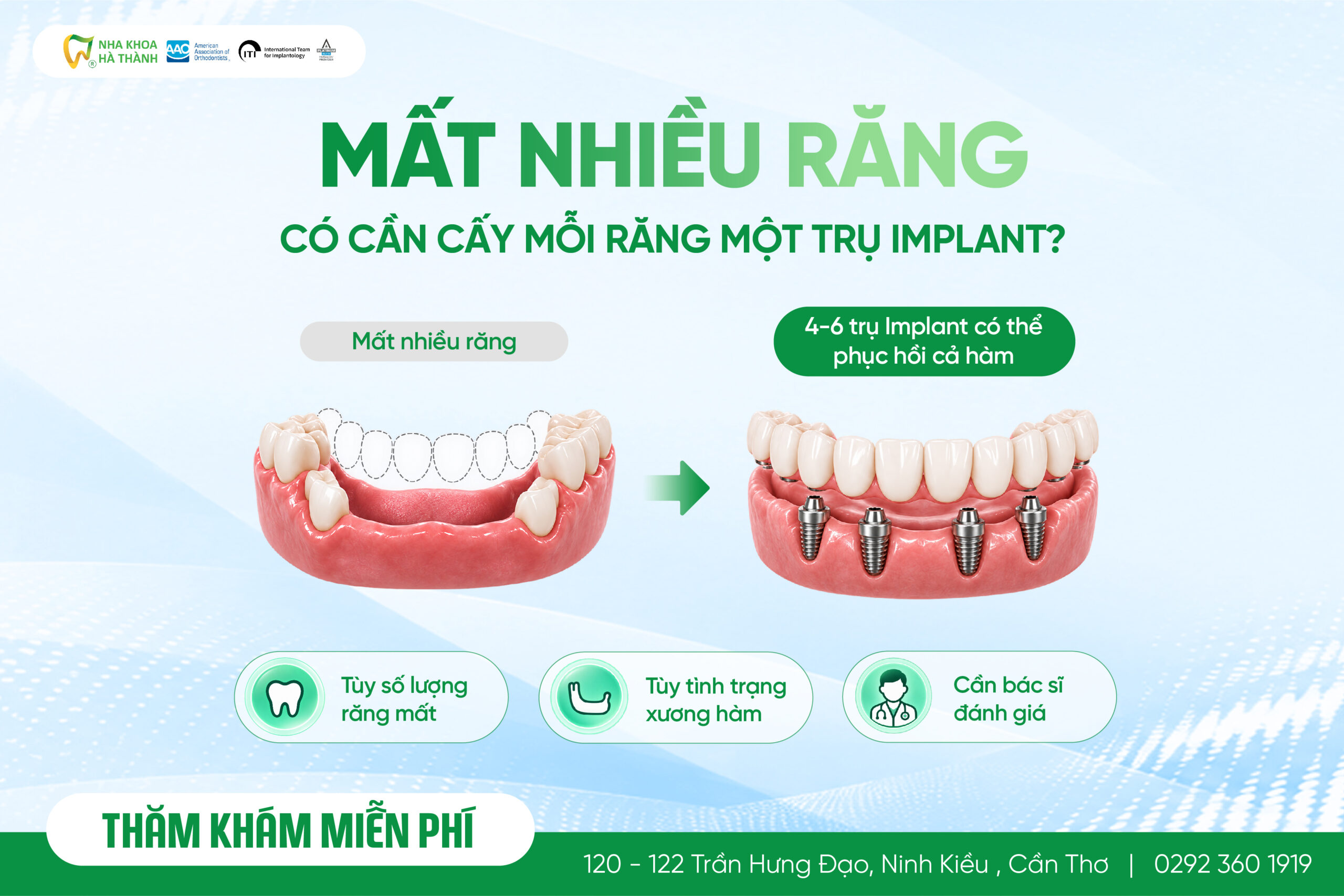 mất nhiều răng cần bao nhiêu Implant